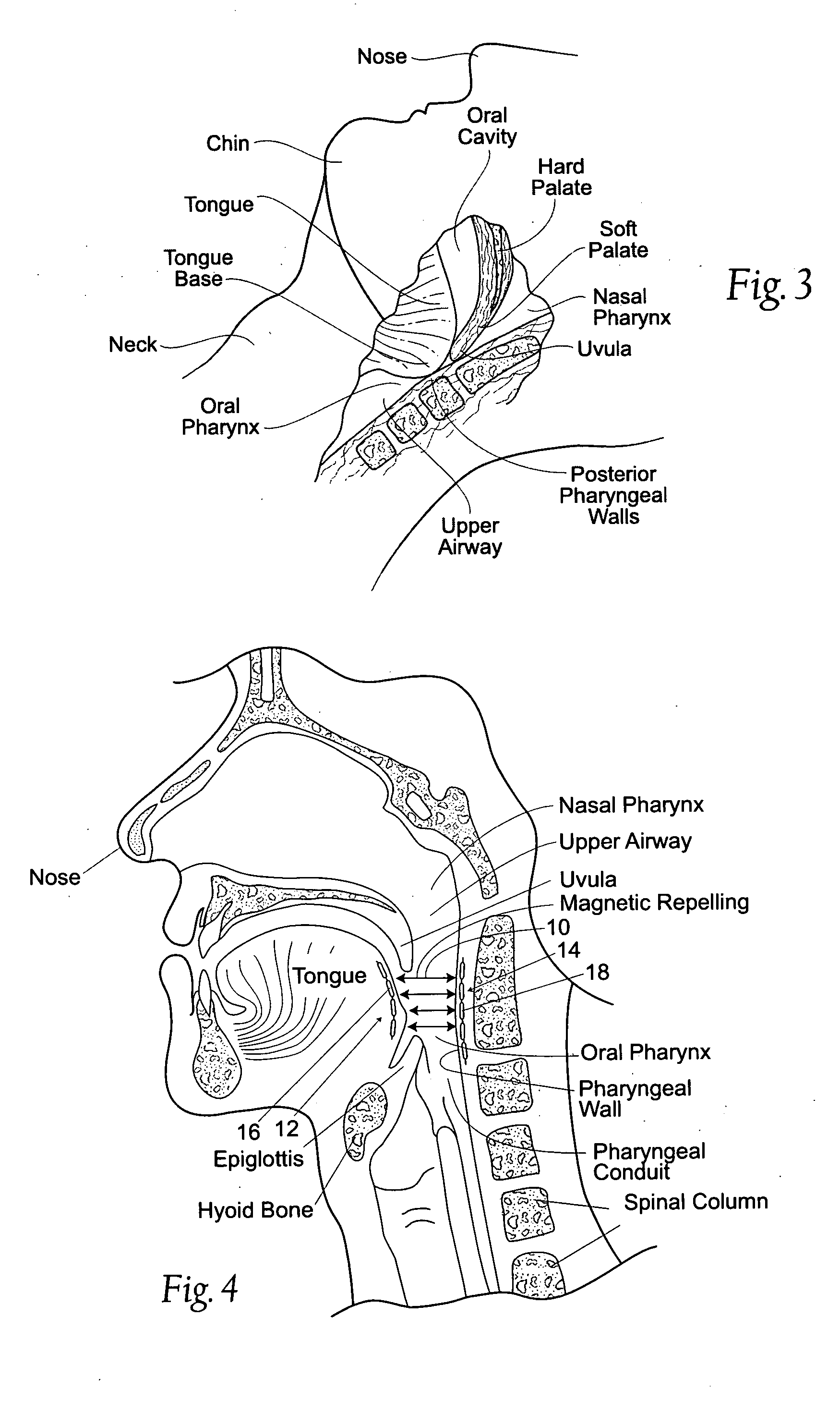 Devices, systems and methods using magnetic force systems in the tongue