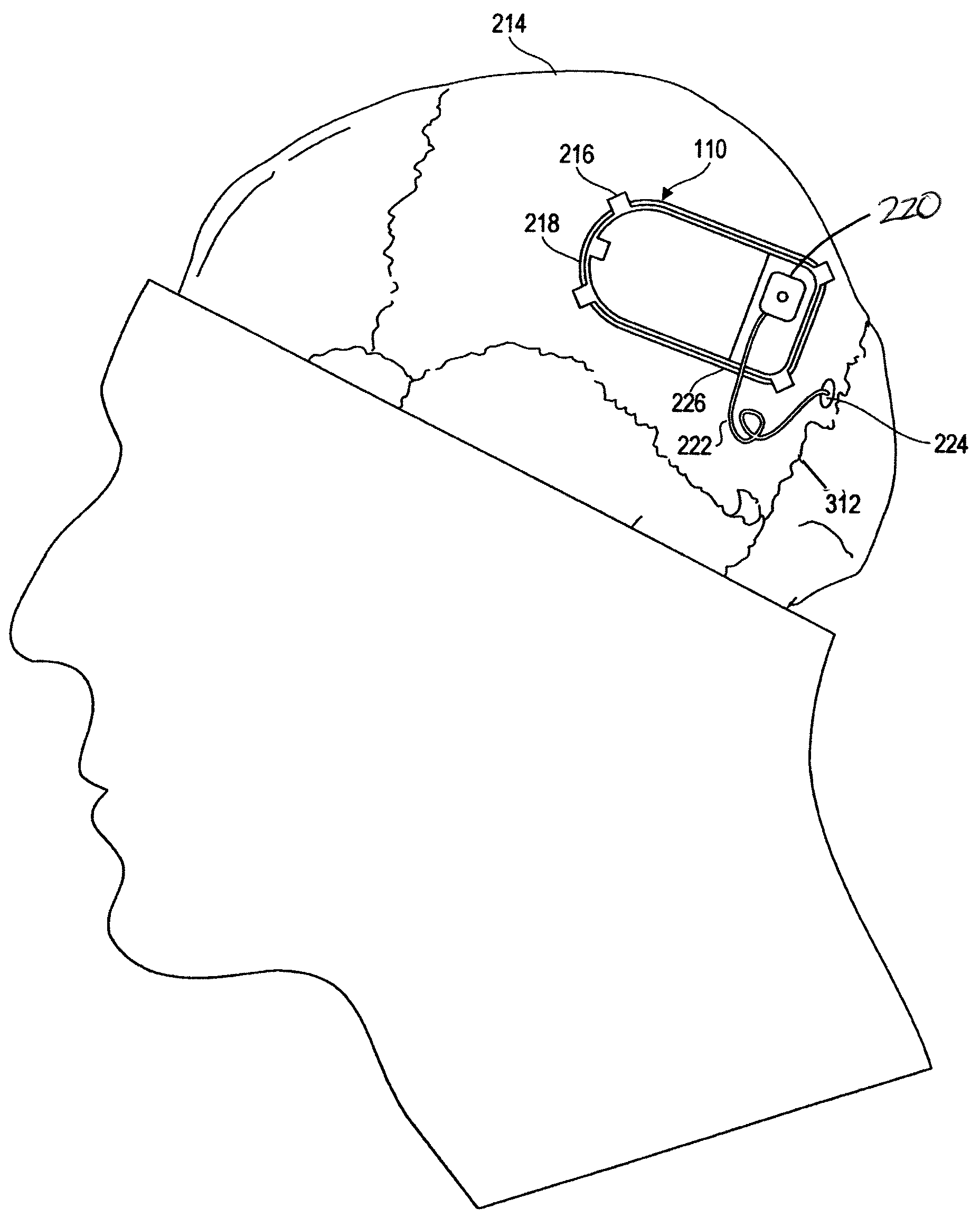 Implantable system enabling responsive therapy for pain