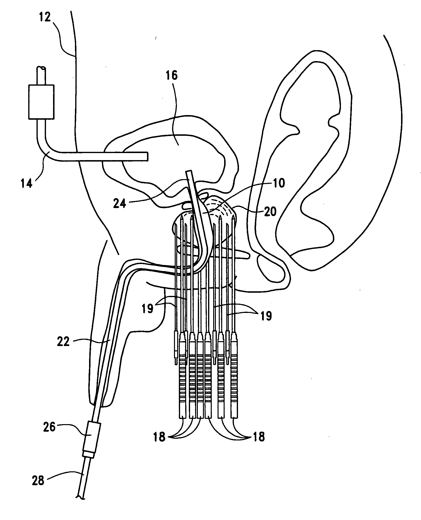 Open system heat exchange catheters and methods of use