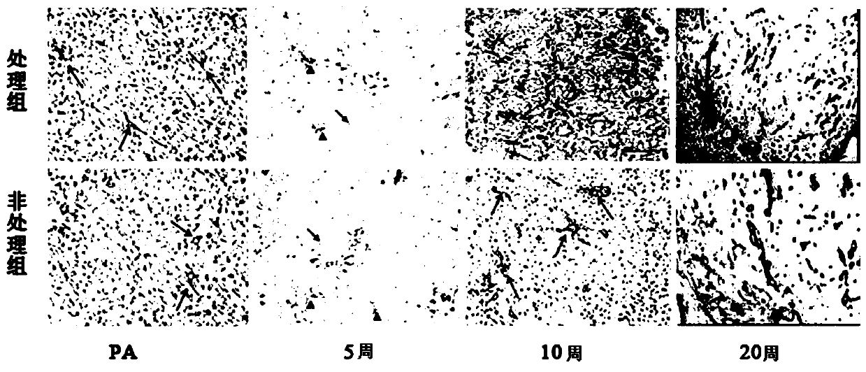 Incubation liquid capable of promoting growth of in vitro tumor tissue capillaries, and preparation method of incubation liquid capable of promoting growth of in vitro tumor tissue capillaries