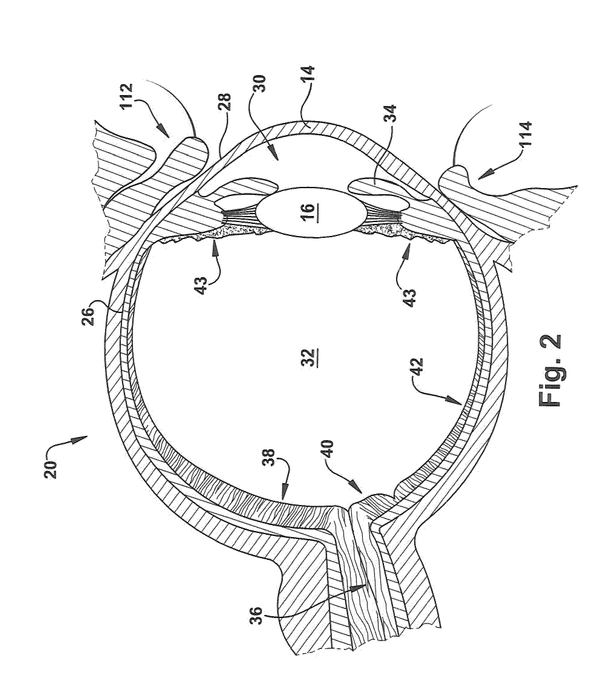 Apparatus and method for delivering a therapeutic agent to ocular tissue