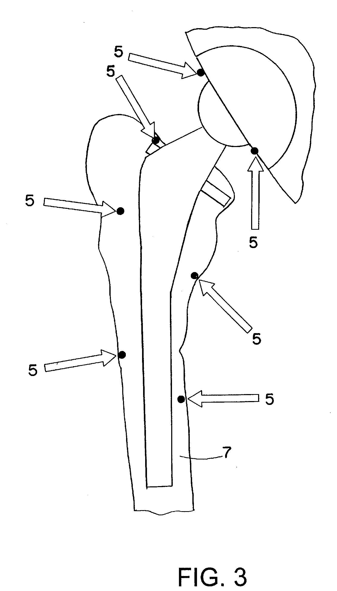 Method and device for registering an anatomical structure using markers