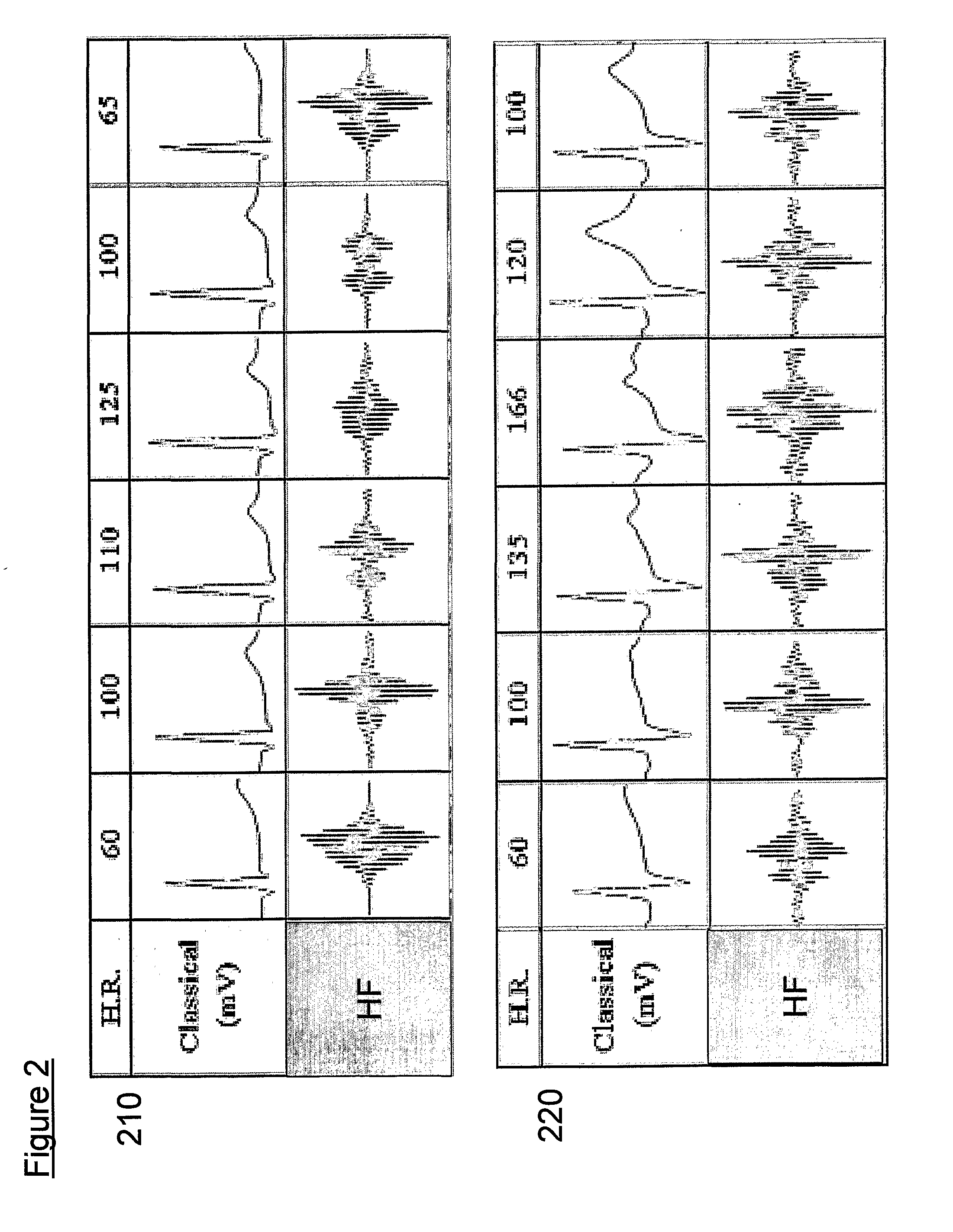 Apparatus and Method for Analysis of High Frequency Qrs Complexes