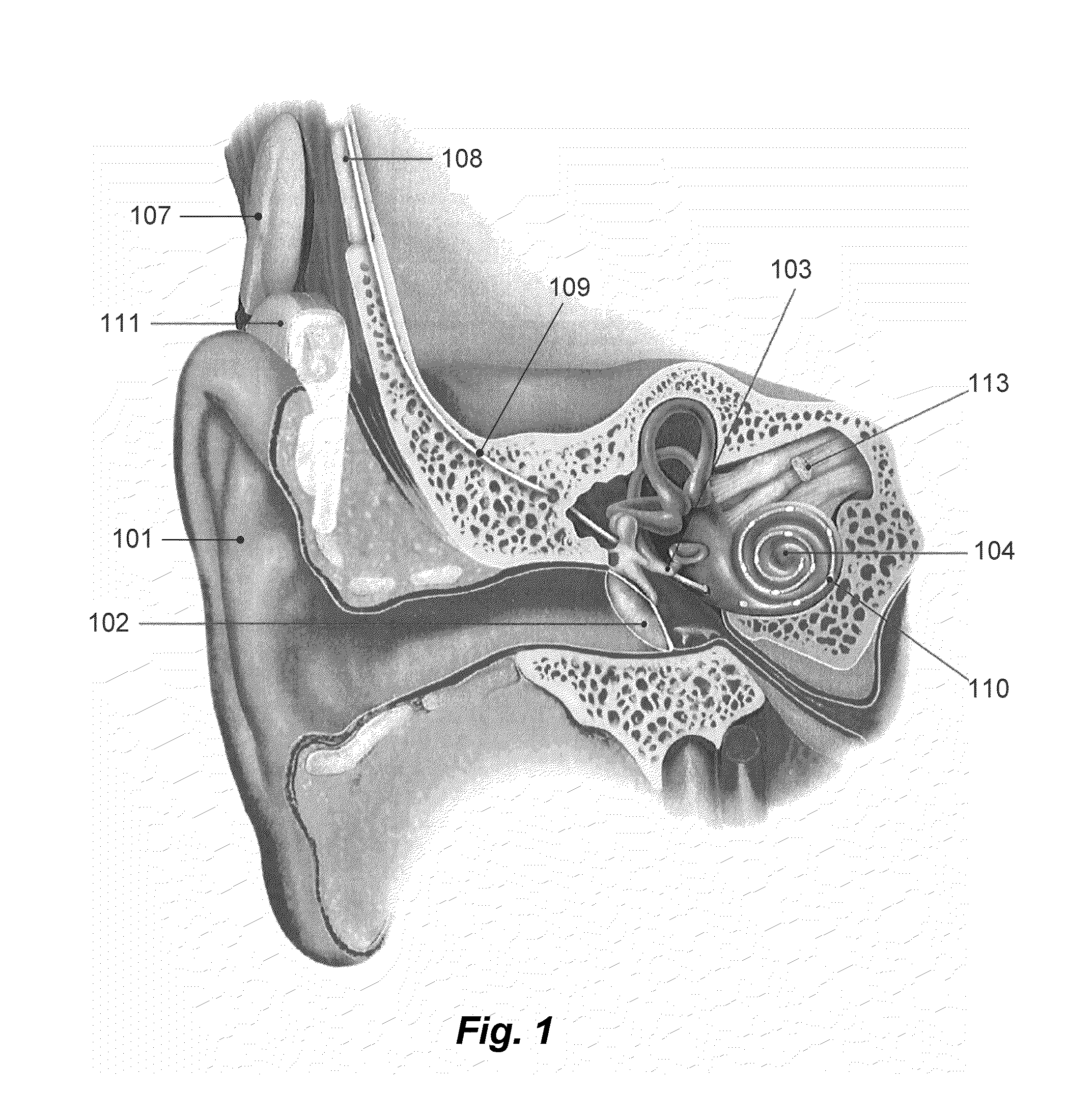 Method for fitting a cochlear implant with patient feedback