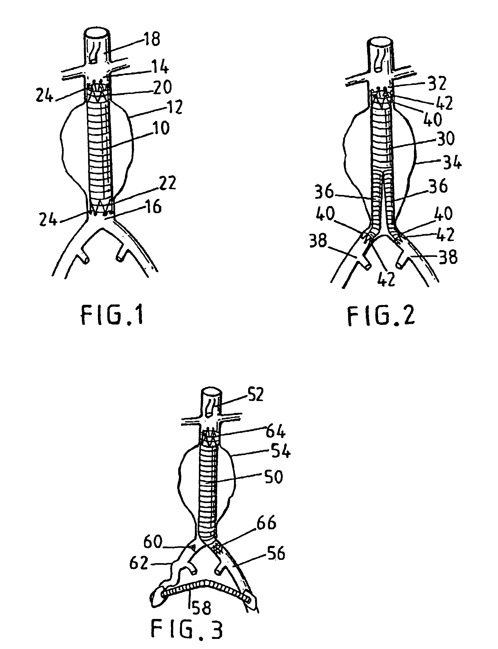 Devices for repairing aneurysms