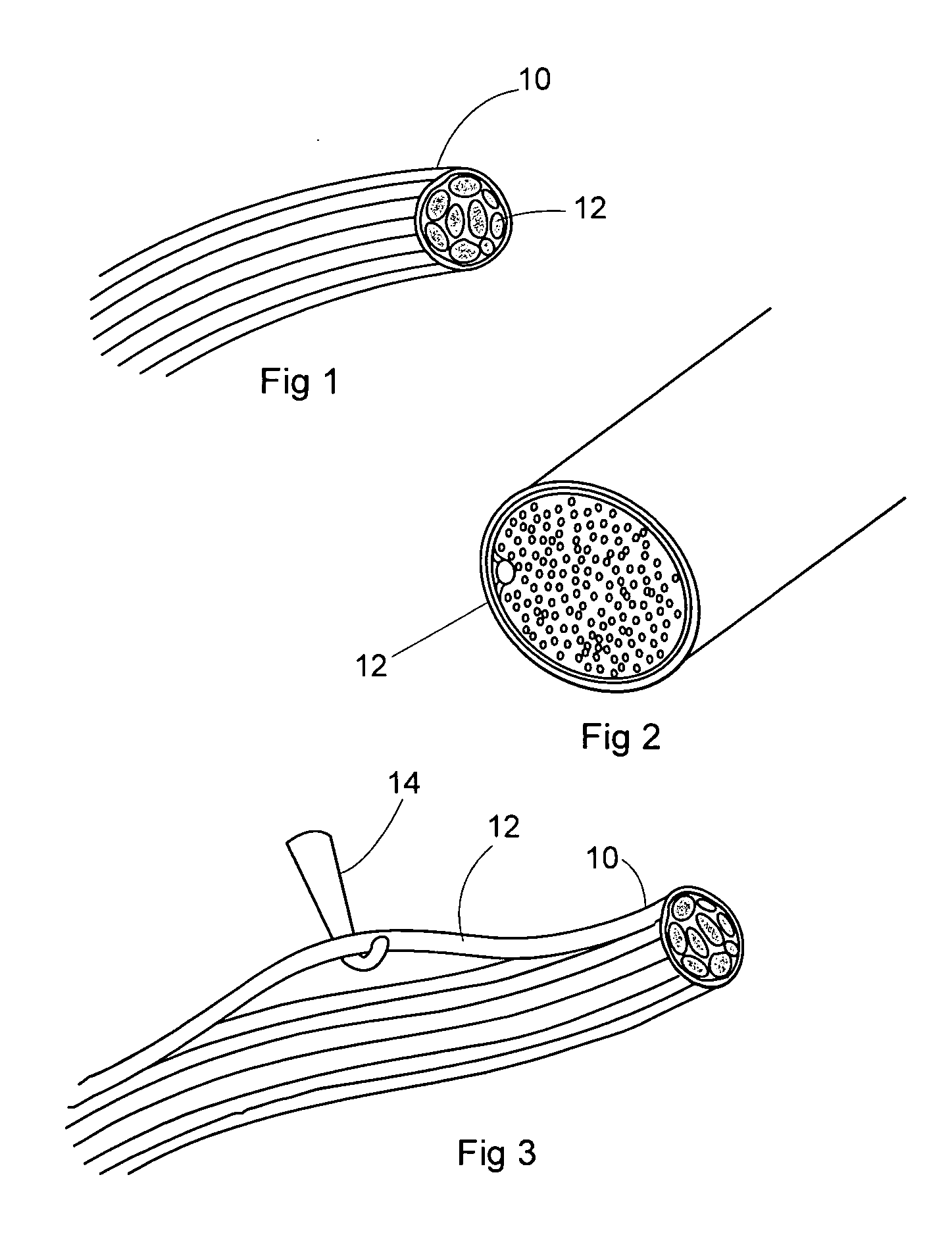 Pelvic implanted neural electrode and method for implanting same