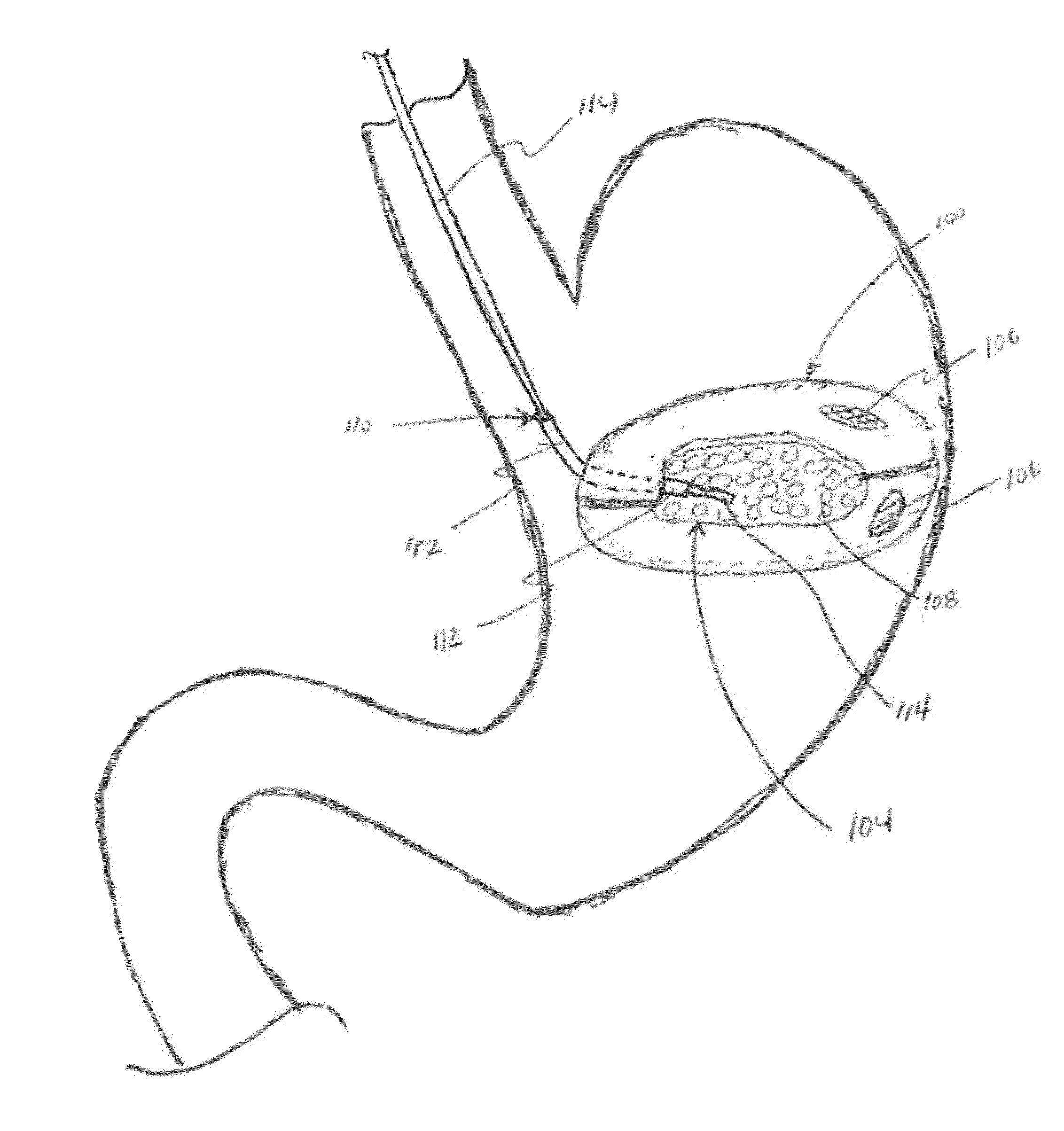 Methods and devices for deploying and releasing a temporary implant within the body