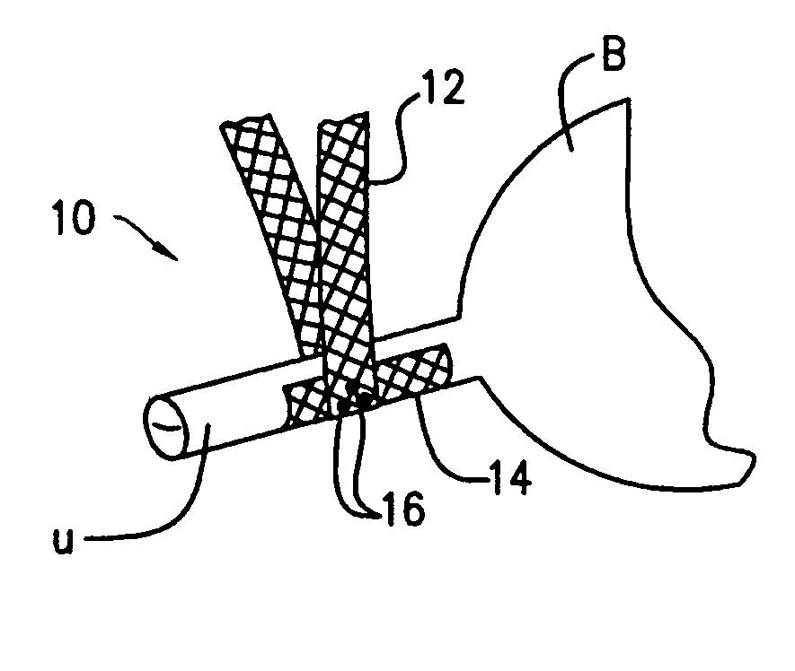 Mesh tape with wing-like extensions for treating female urinary incontinence