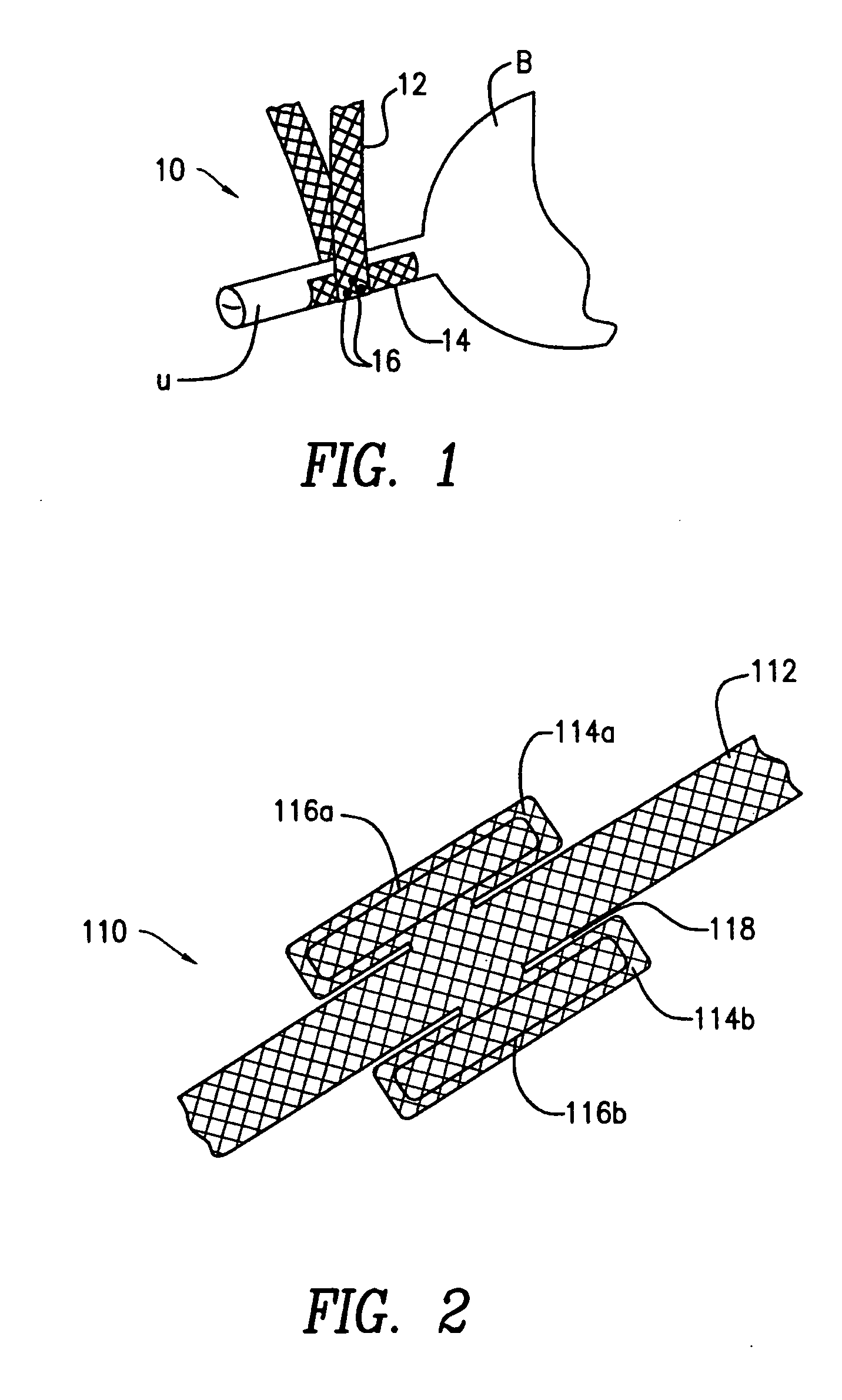Mesh tape with wing-like extensions for treating female urinary incontinence
