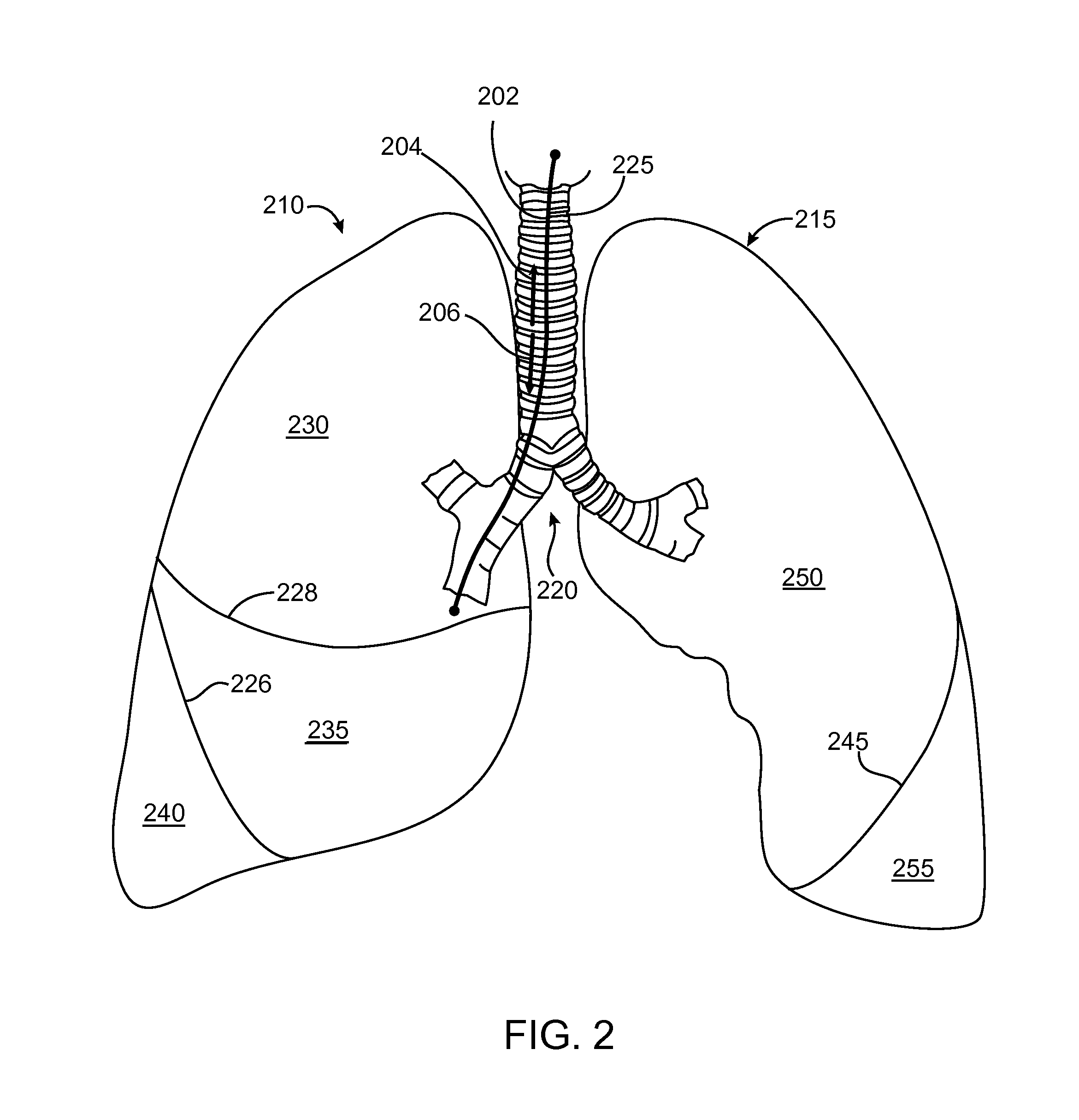 Implanted bronchial isolation devices and methods