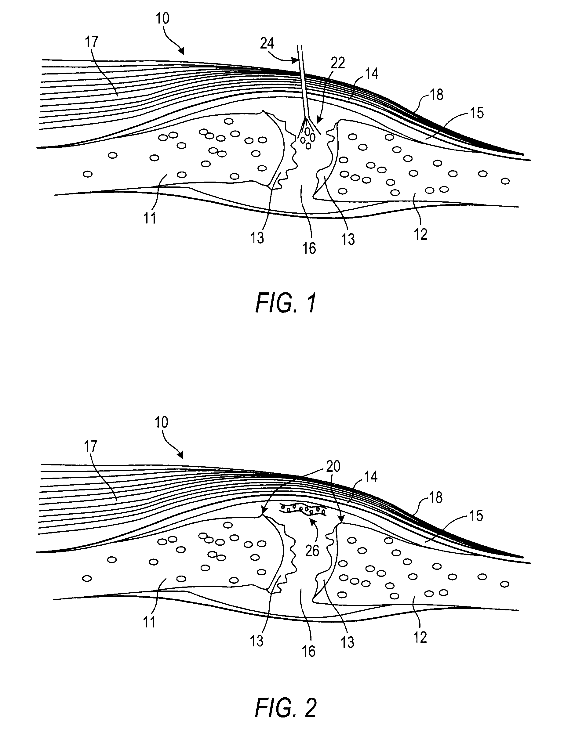 Flowable composition that sets to a substantially non-flowable state