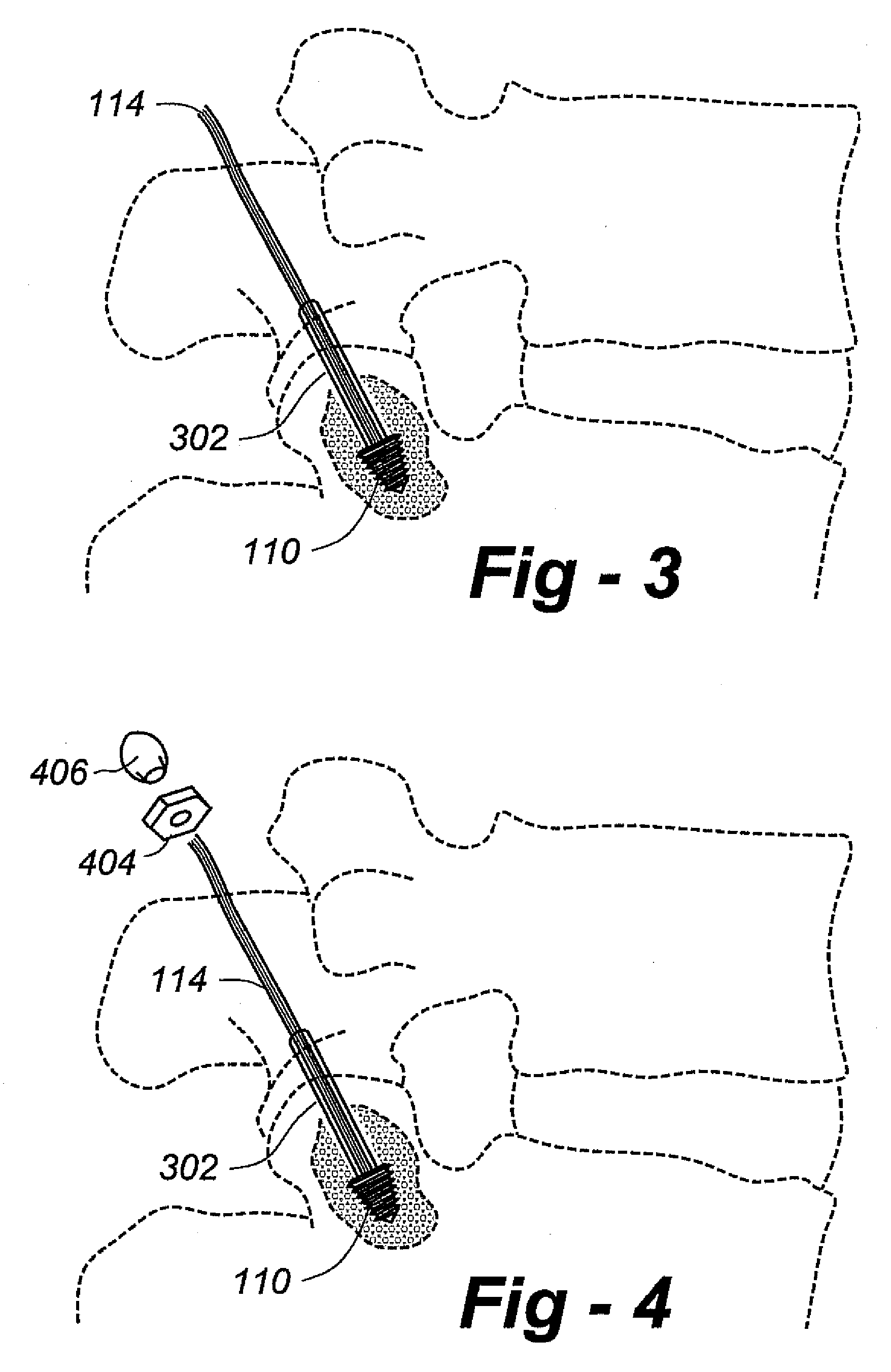 Dynamic/static facet fixation device and method