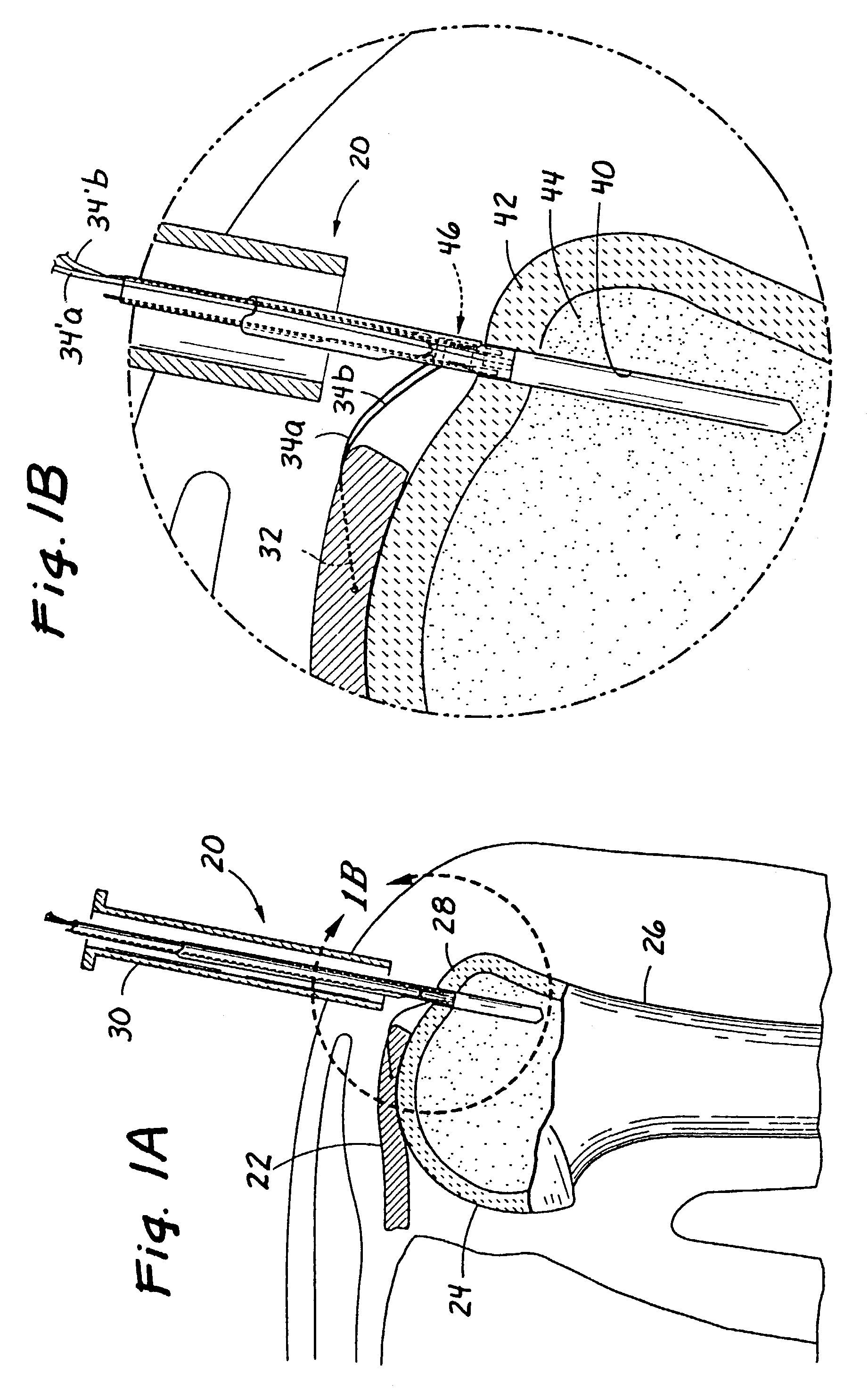 Devices and methods for repairing soft tissue