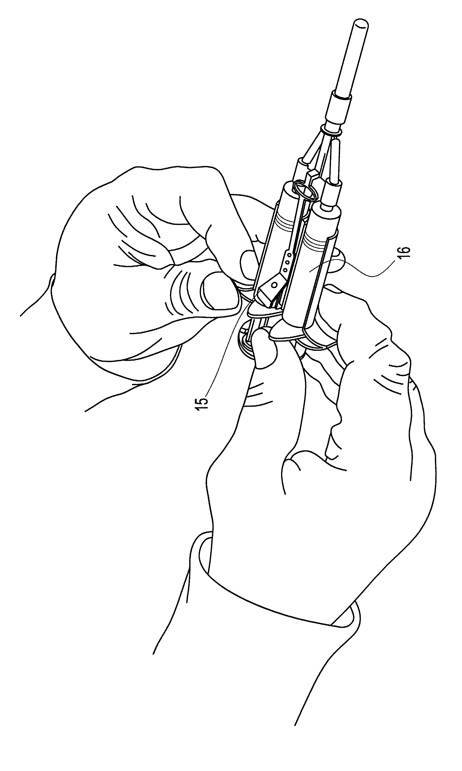 Method of arthroscopic osteochondral resurfacing using prp strengthened with fibrin glue