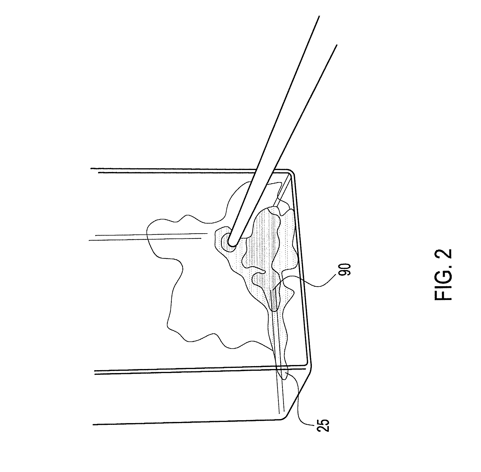 Method of arthroscopic osteochondral resurfacing using prp strengthened with fibrin glue