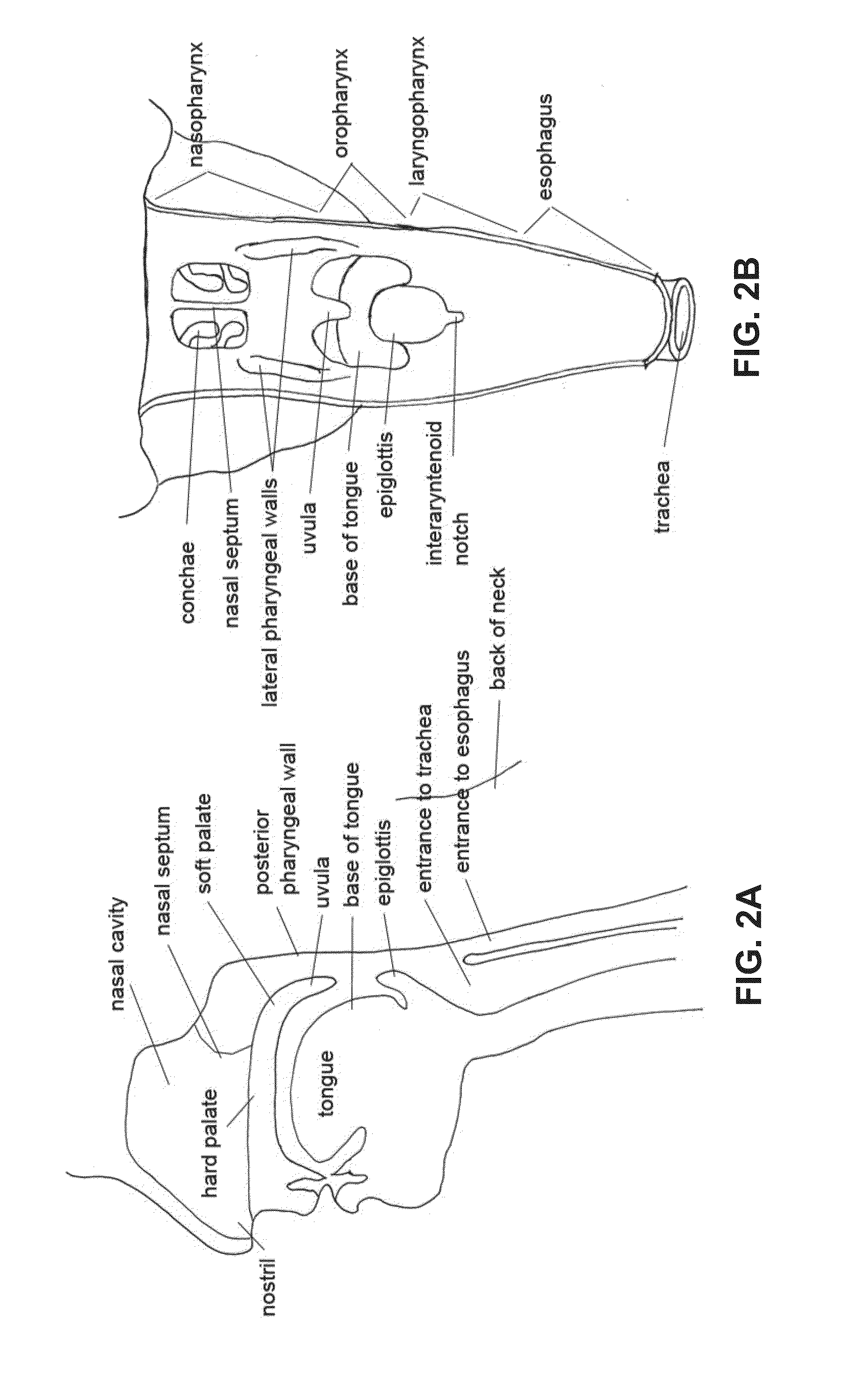 Devices and methods for treating sleep disordered breathing