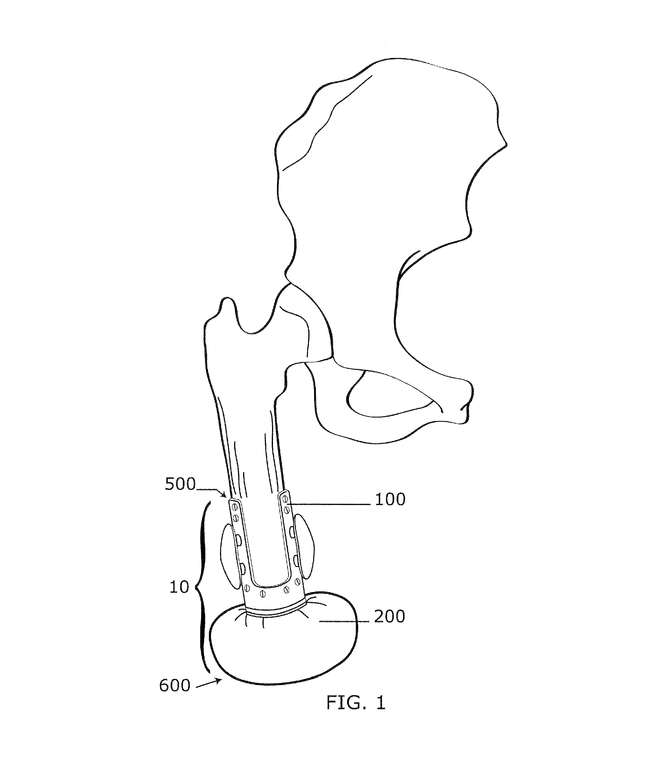 Implantable Prosthetic Device For Distribution Of Weight On Amputated Limb And Method Of Use With An External Prosthetic Device