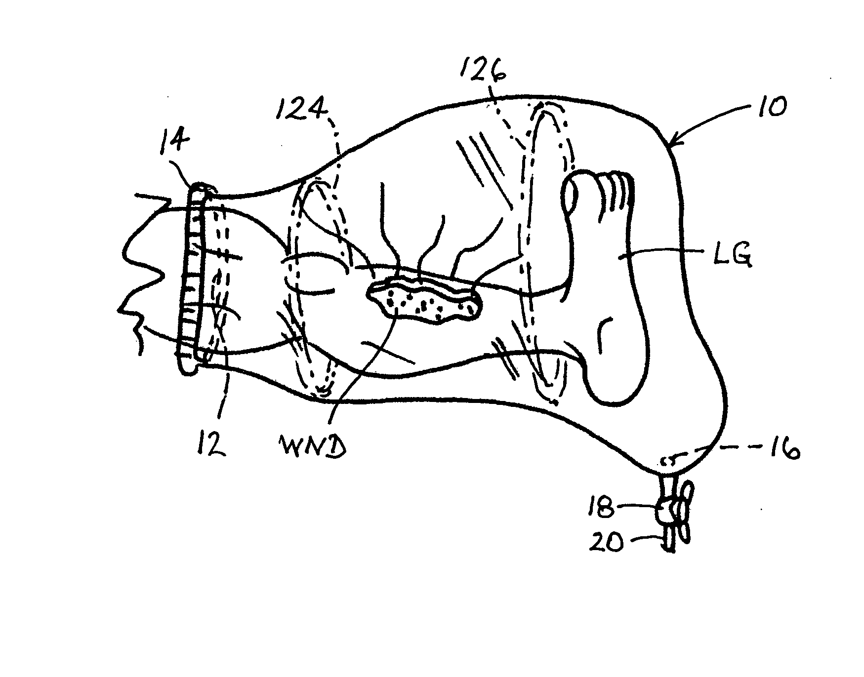 Fluid containment apparatus for surgery and method of use