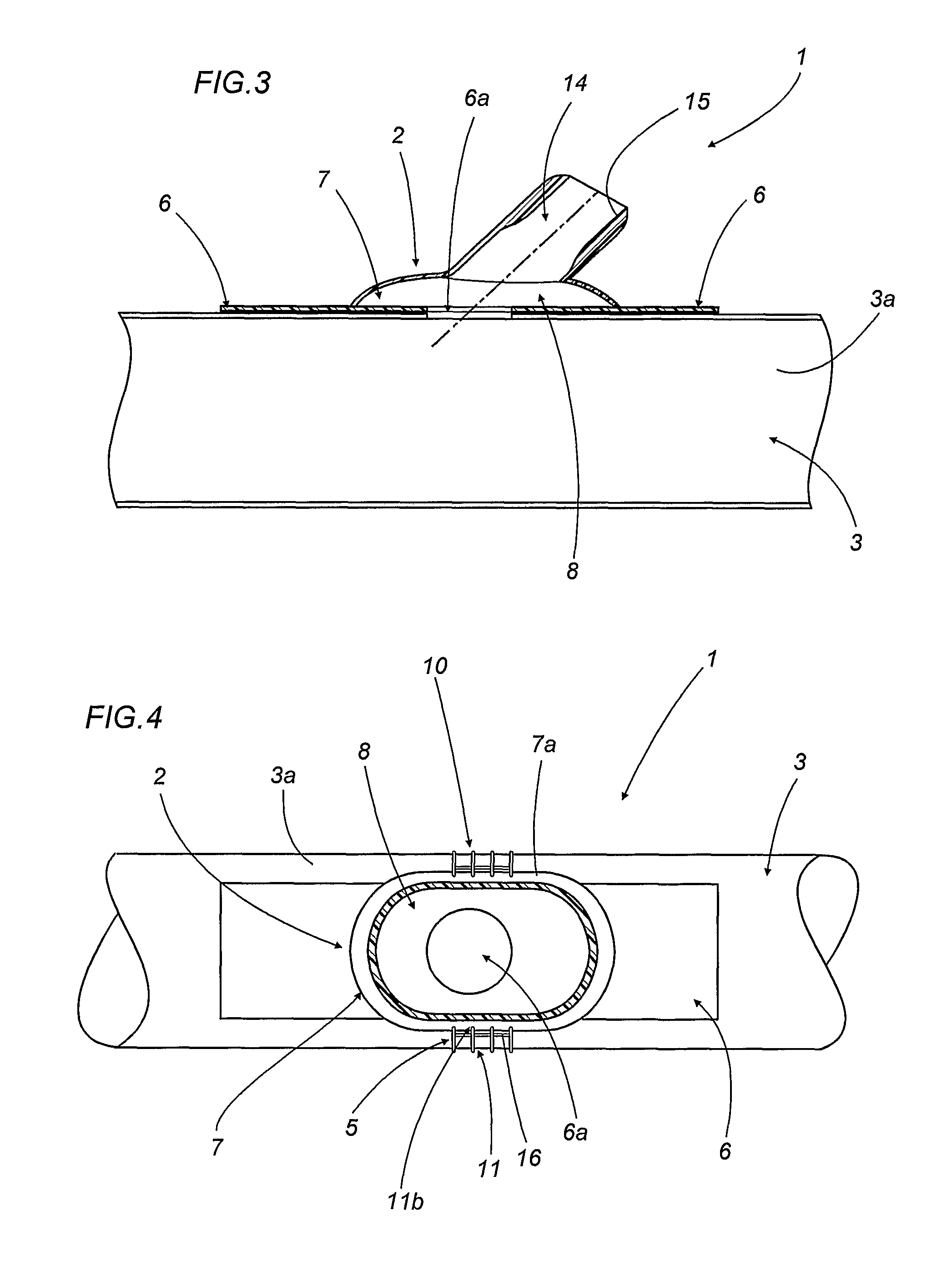Device for end-to-side anastomosis