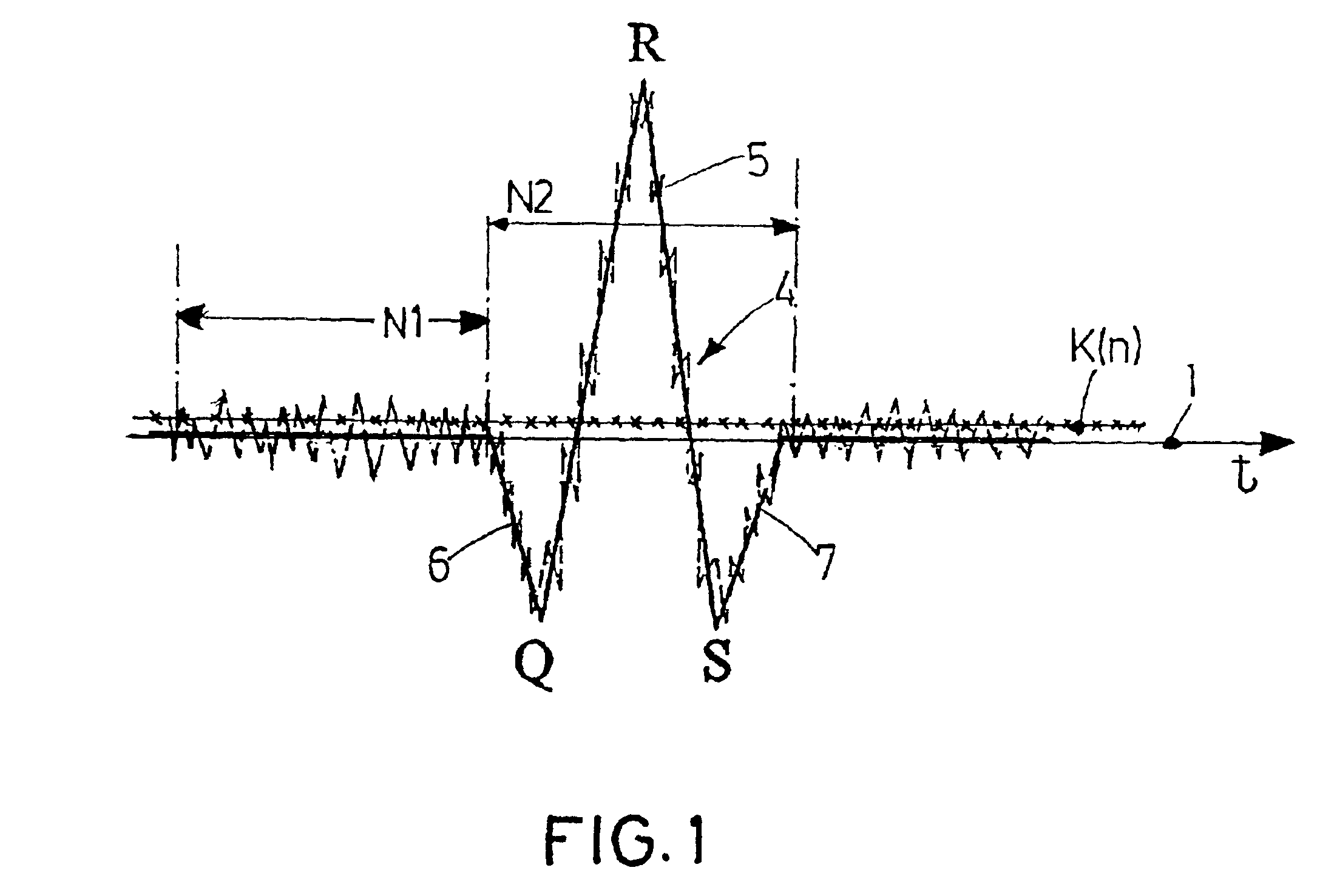 Signal evaluation method for detecting QRS complexes in electrocardiogram signals