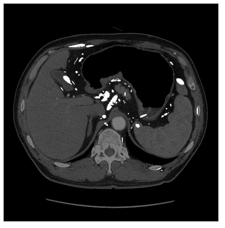 System and method for detecting lymph nodes in gastric CT images based on shape and ellipse fitting