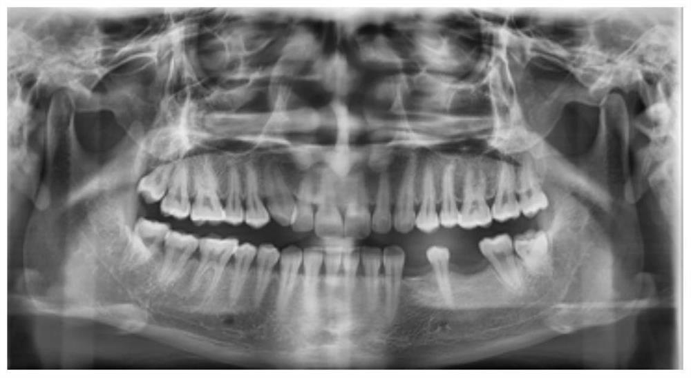 Device and method for assisting invisible orthodontic treatment of mesial mobile molars