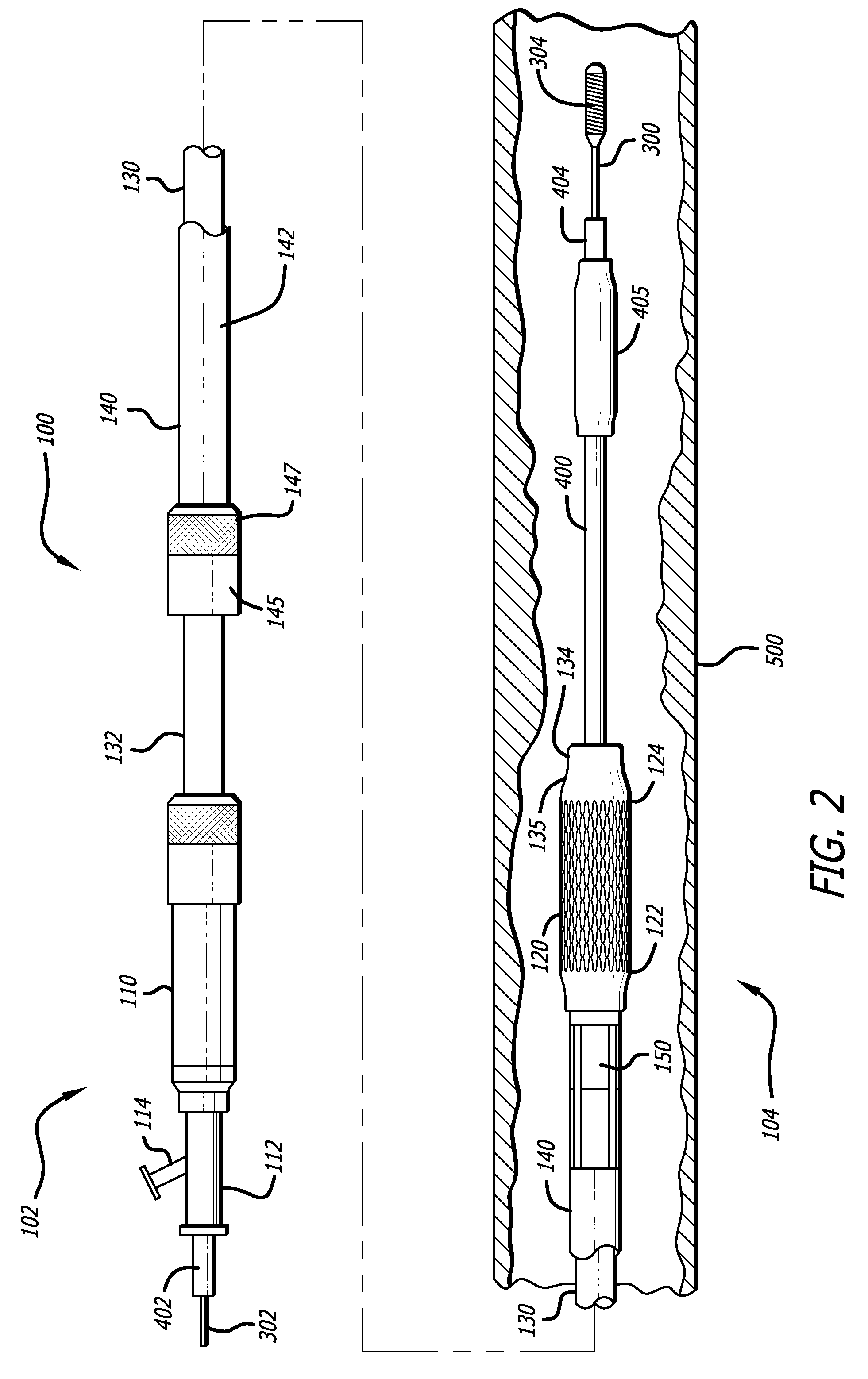 Ostial lesion stent delivery system