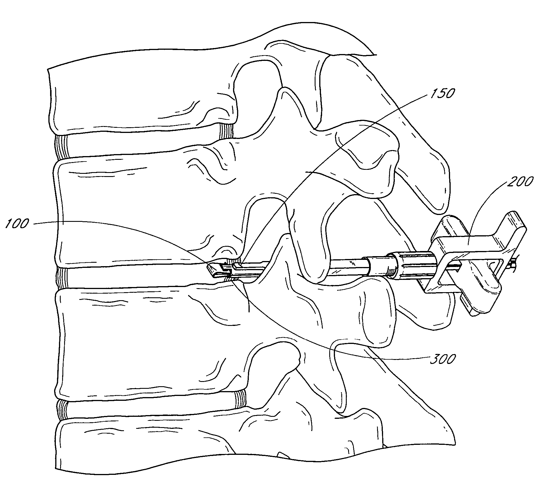 Device for delivering an implant through an annular defect in an intervertebral disc