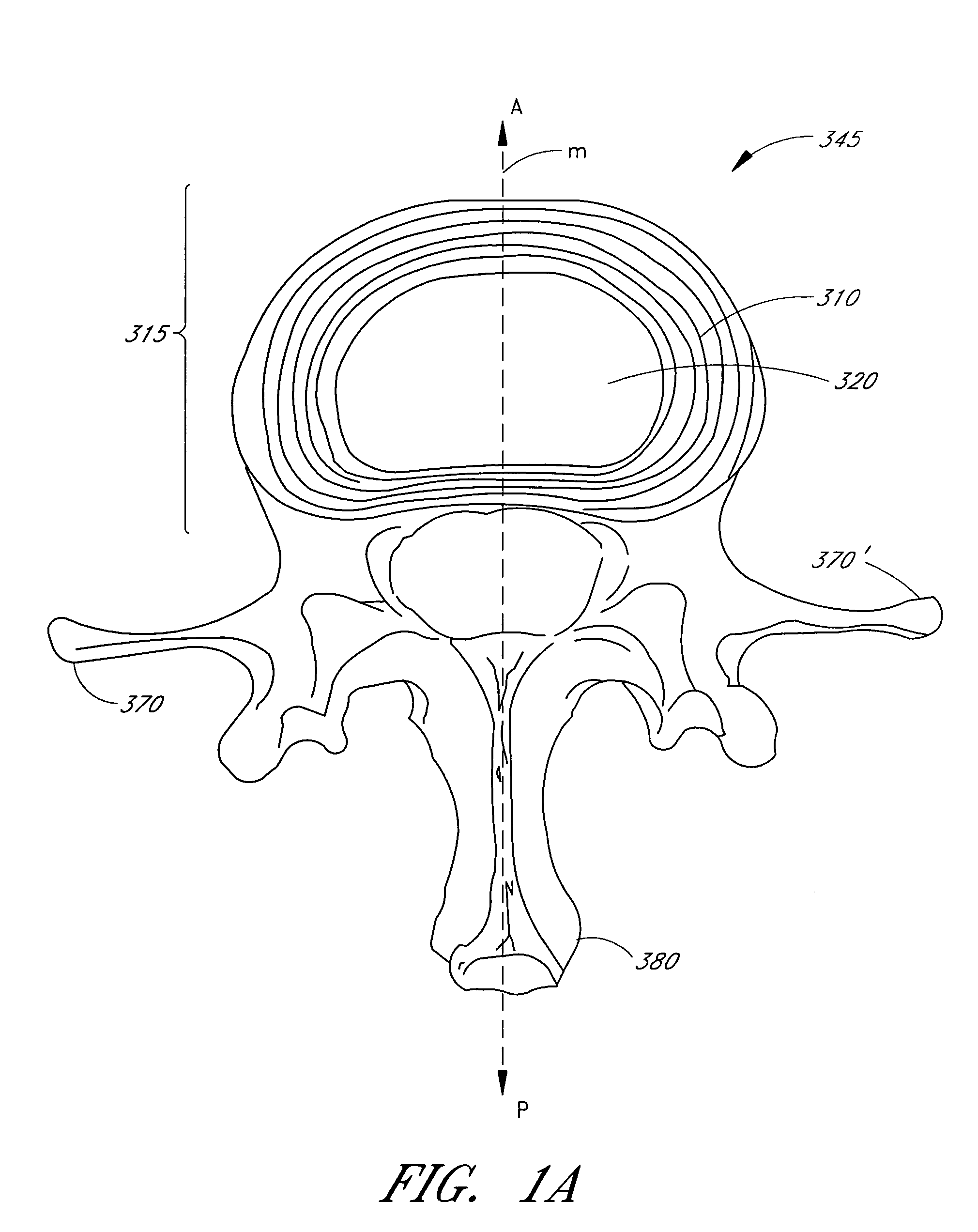 Device for delivering an implant through an annular defect in an intervertebral disc