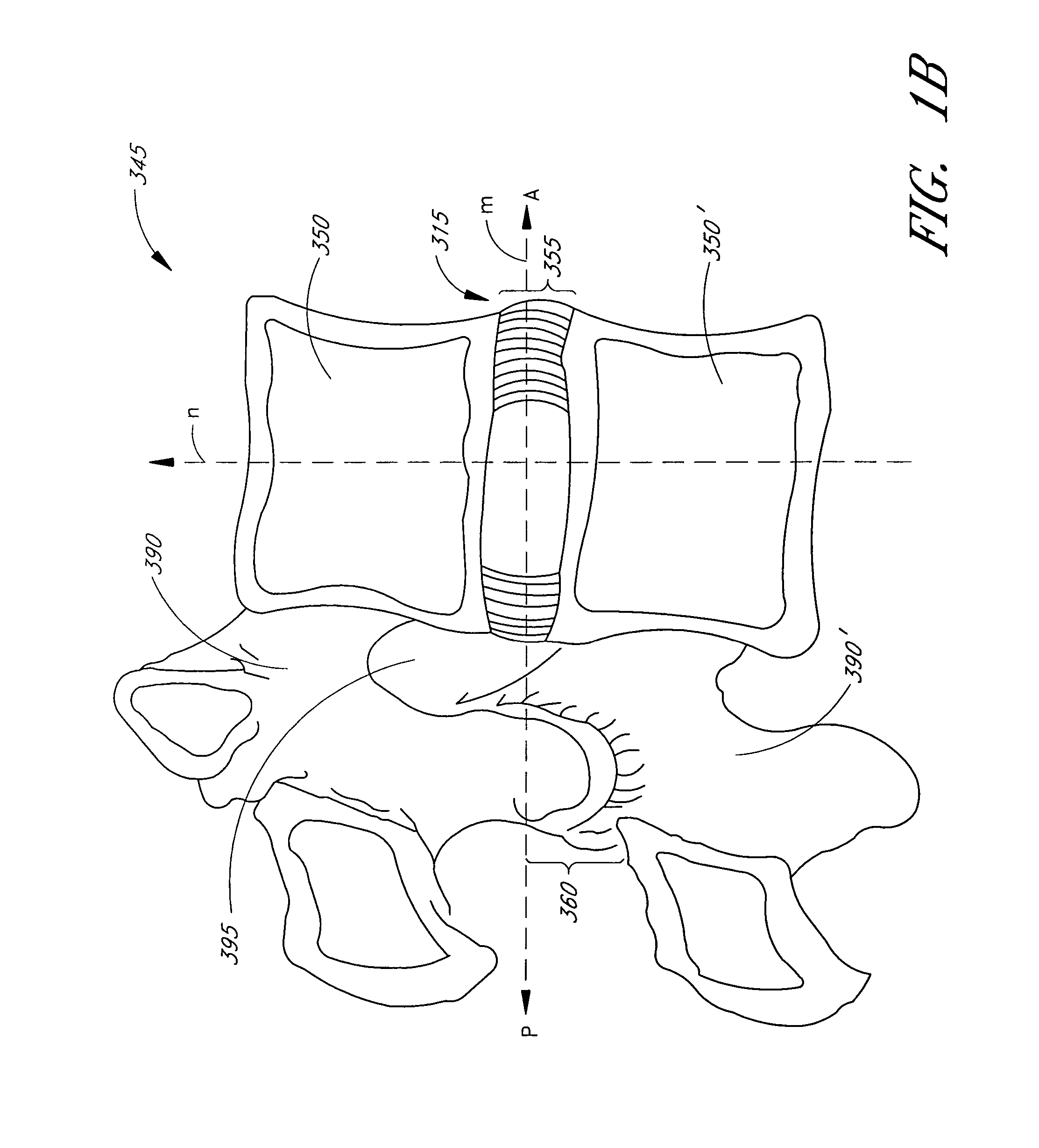 Device for delivering an implant through an annular defect in an intervertebral disc