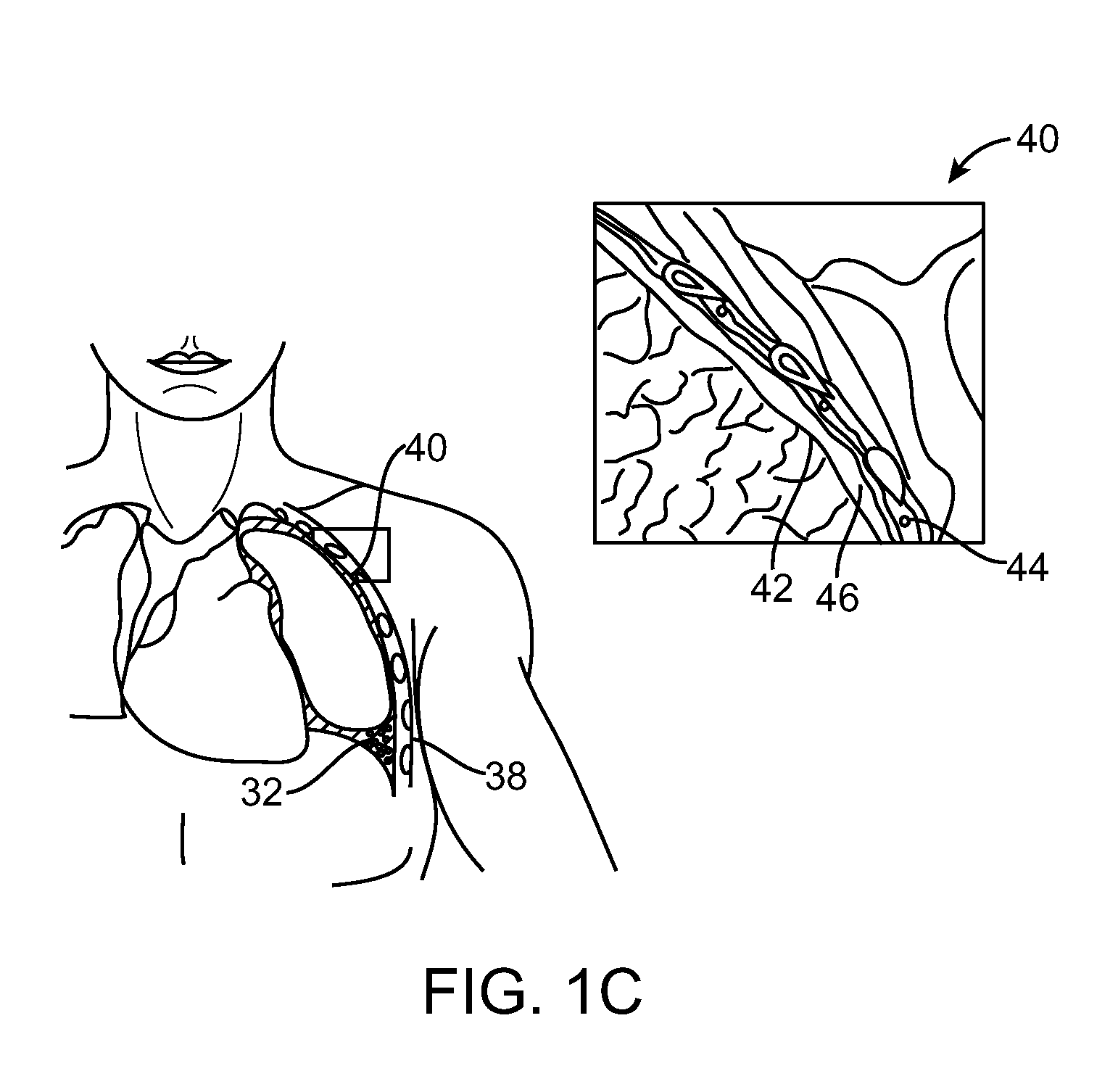 Lung Volume Reduction Devices, Methods, and Systems