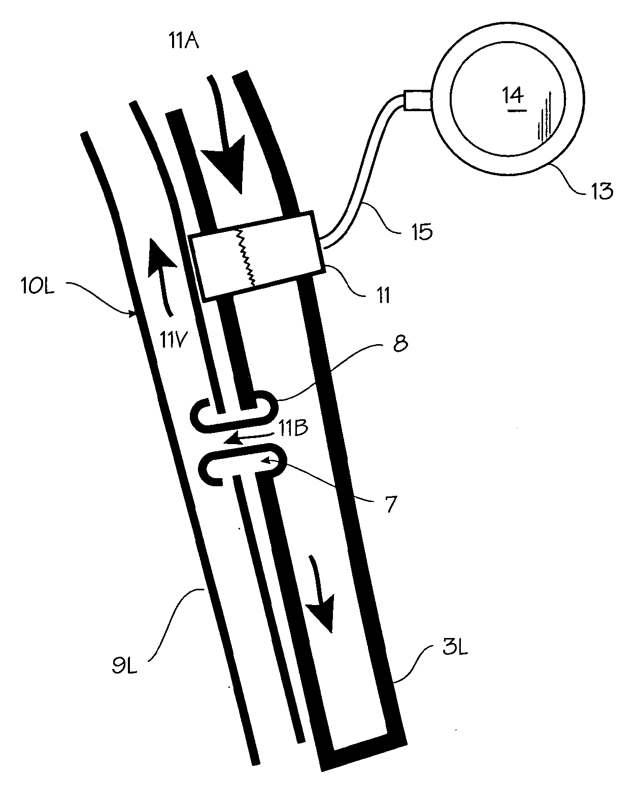 Method of treating COPD with artificial arterio-venous fistula and flow mediating systems