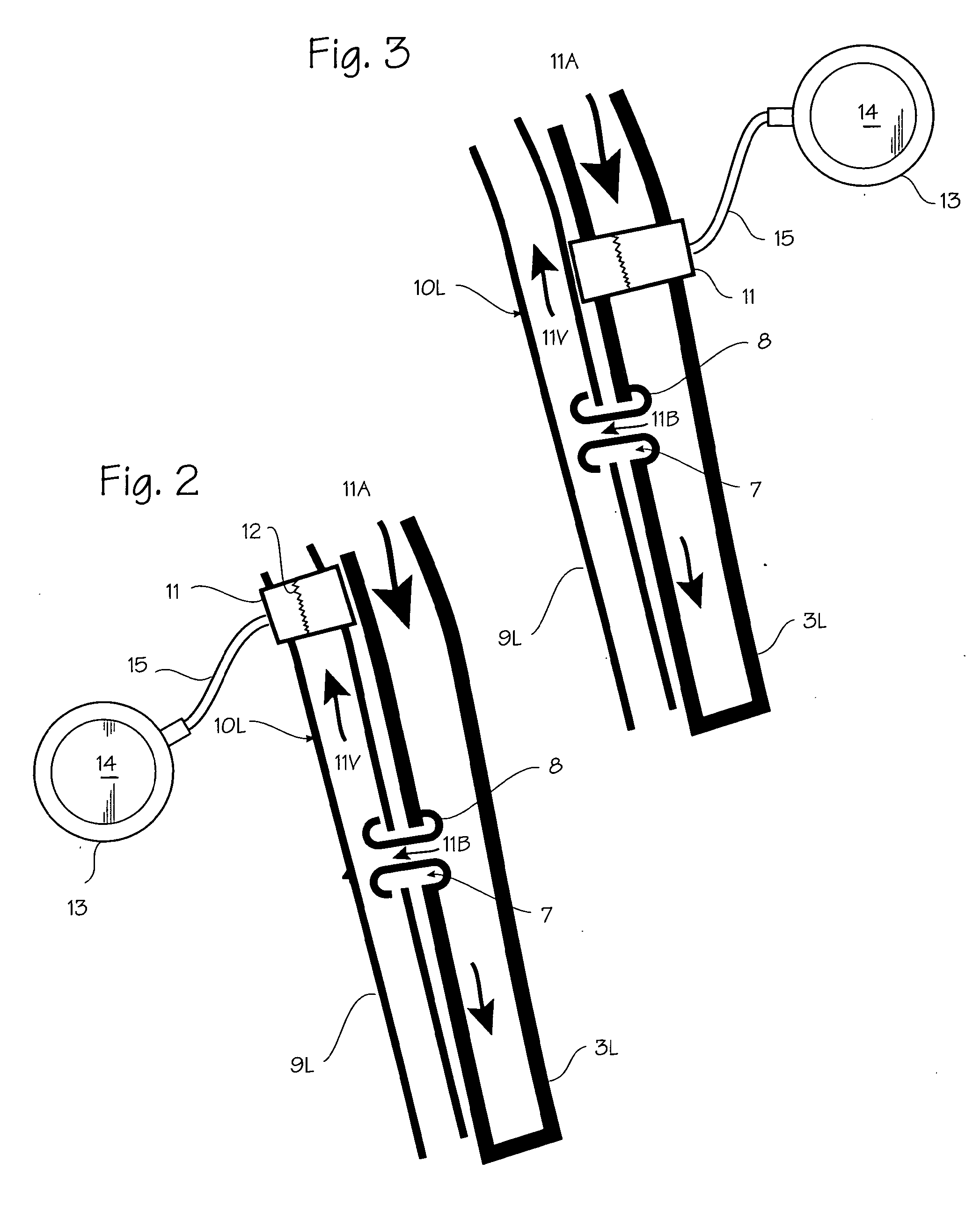 Method of treating COPD with artificial arterio-venous fistula and flow mediating systems