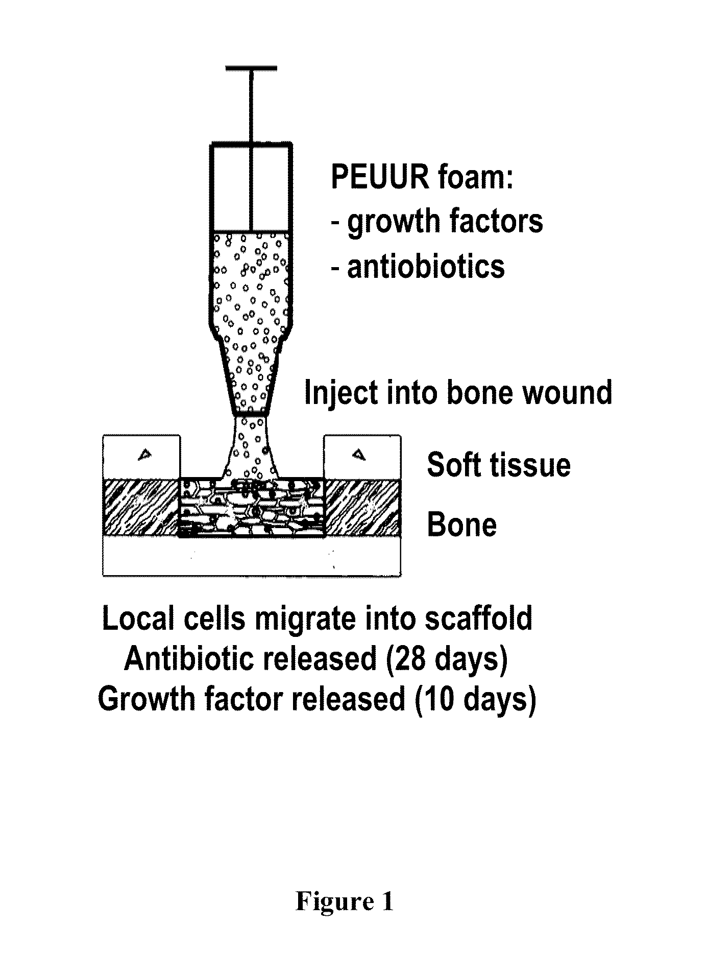 Injectable dual delivery allograph bone/polymer composite for treatment of open fractures