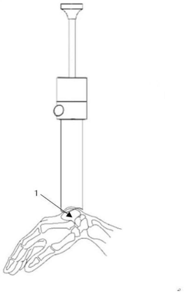 A treatment instrument for ganglion cyst based on the principle of impact dynamics
