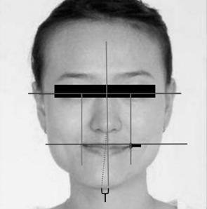 Multifunctional Facial Deviation Measuring and Indicating Device