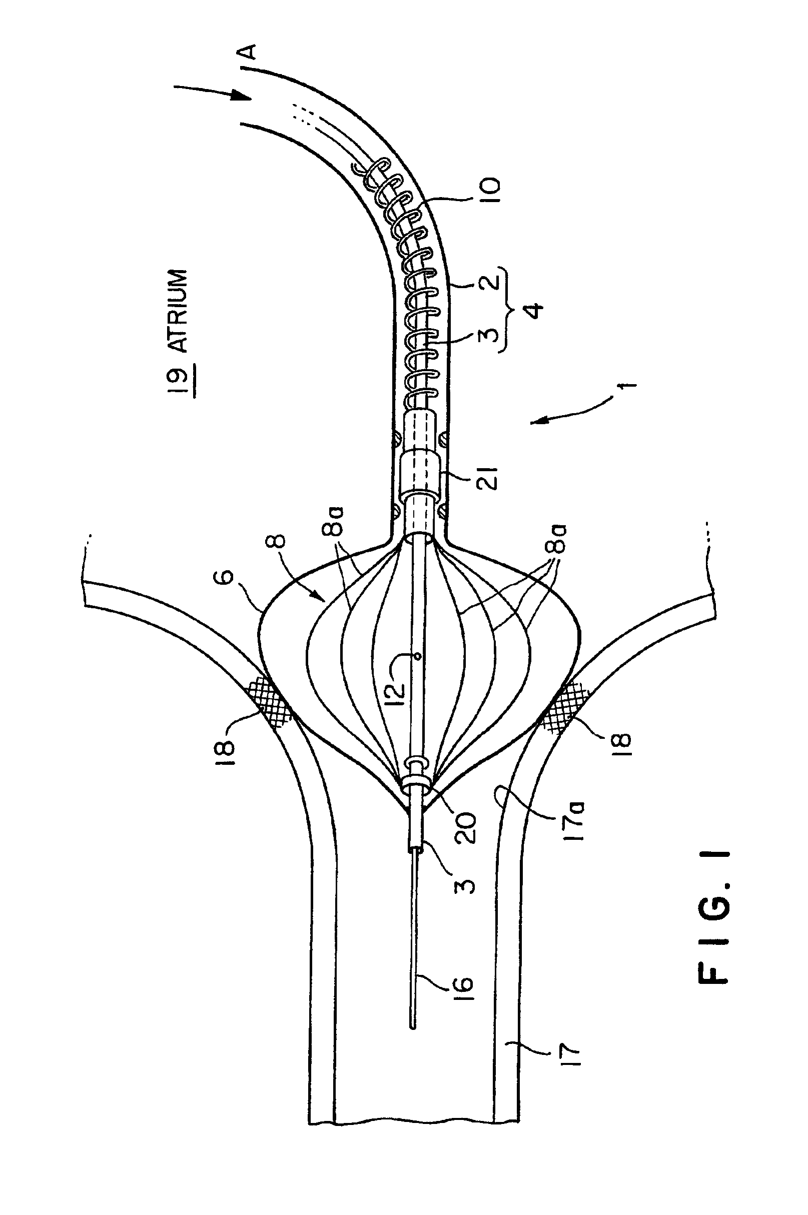 Radiofrequency thermal balloon catheter