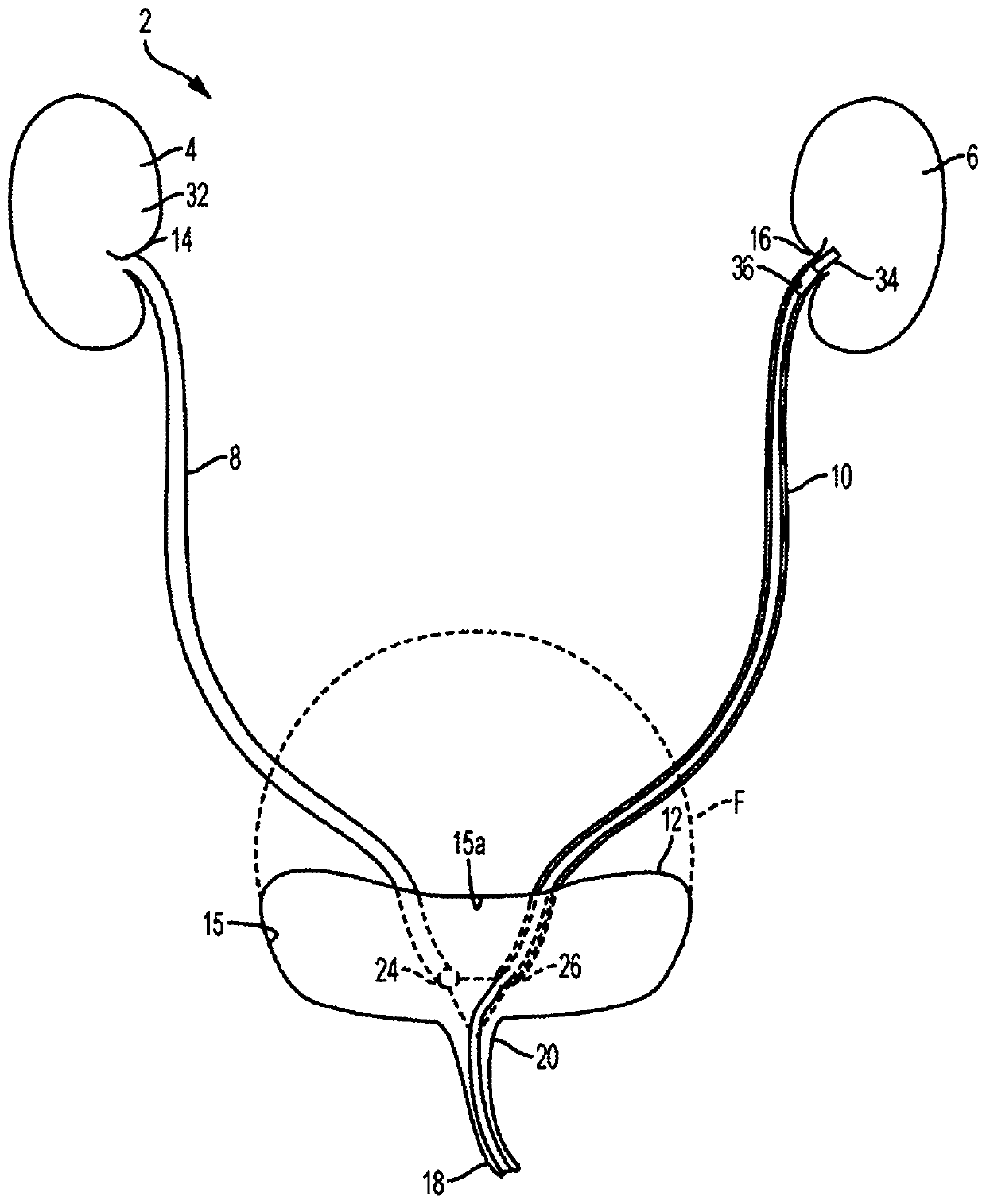 Indwelling pump for facilitating removal of urine from the urinary tract