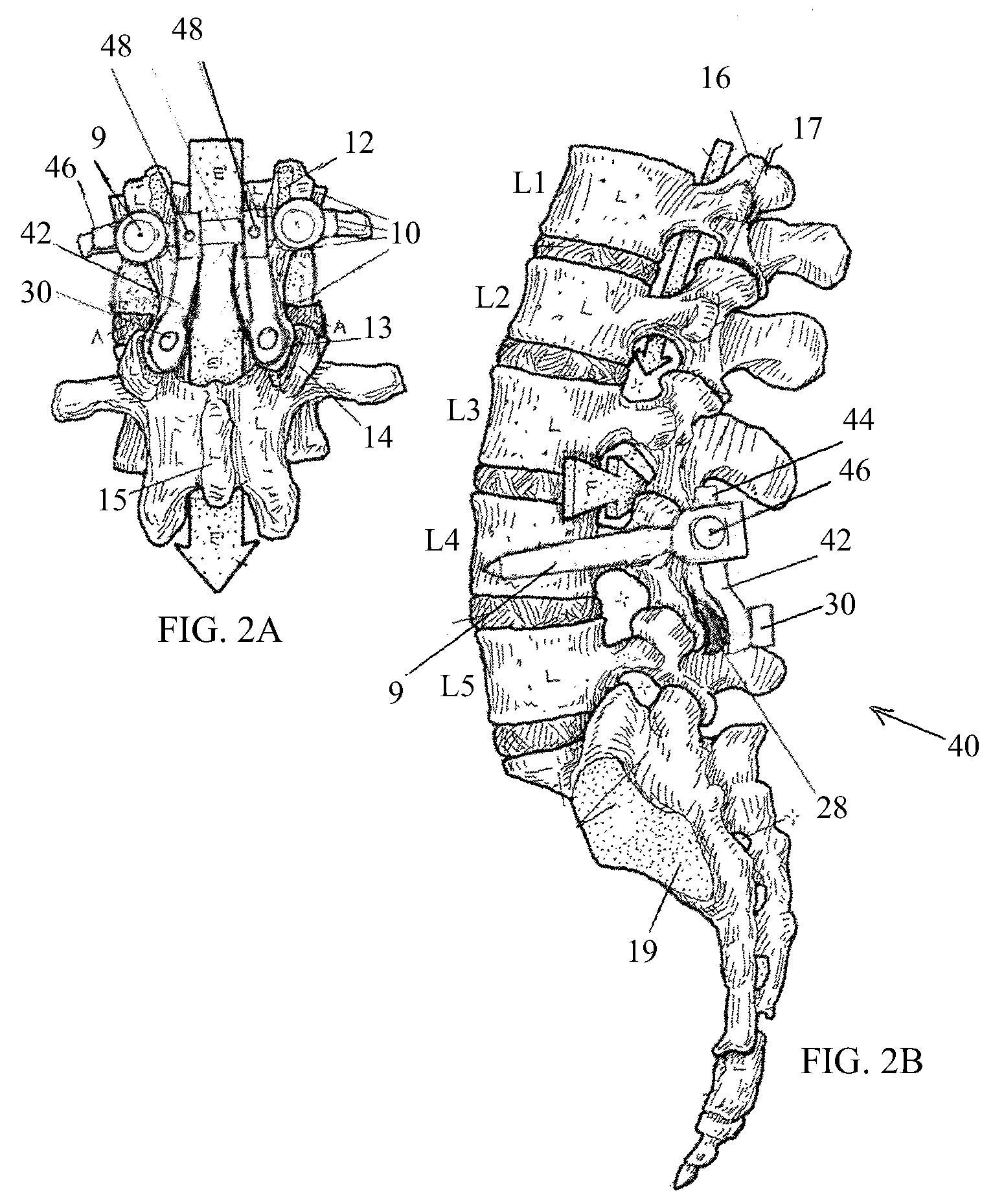 Posterior-medial facet support assembly