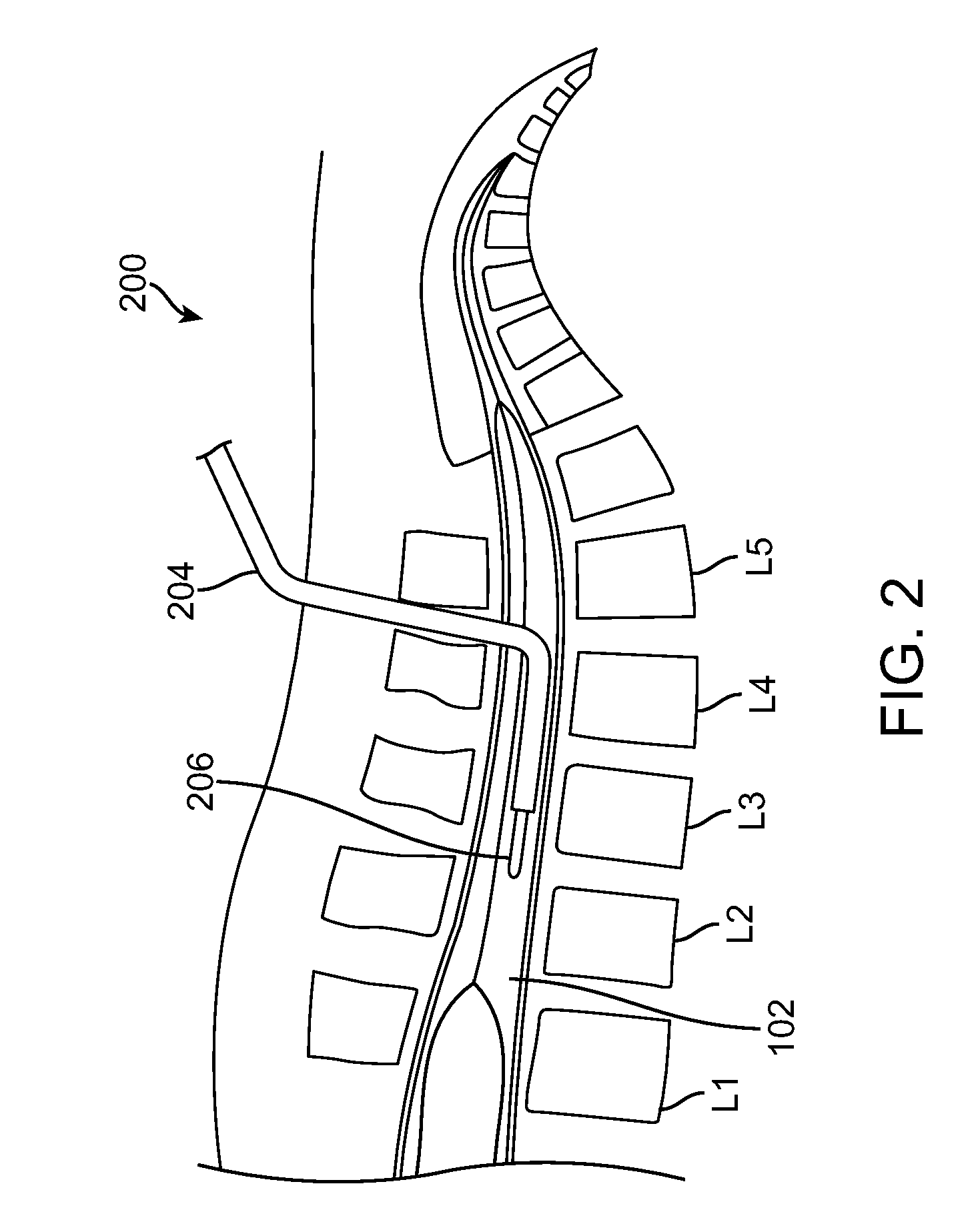Methods for Simultaneous Injection and Aspiration of Fluids During a Medical Procedure