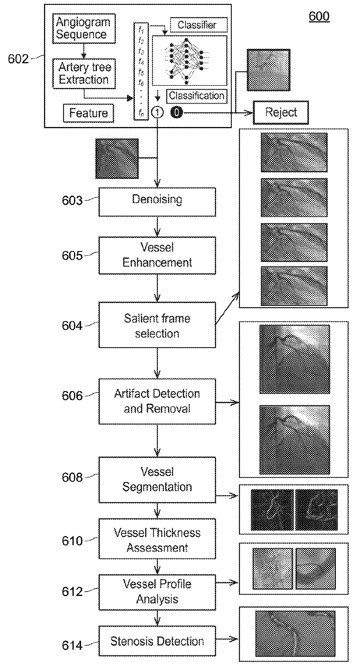 Automated analysis of vasculature in coronary angiograms