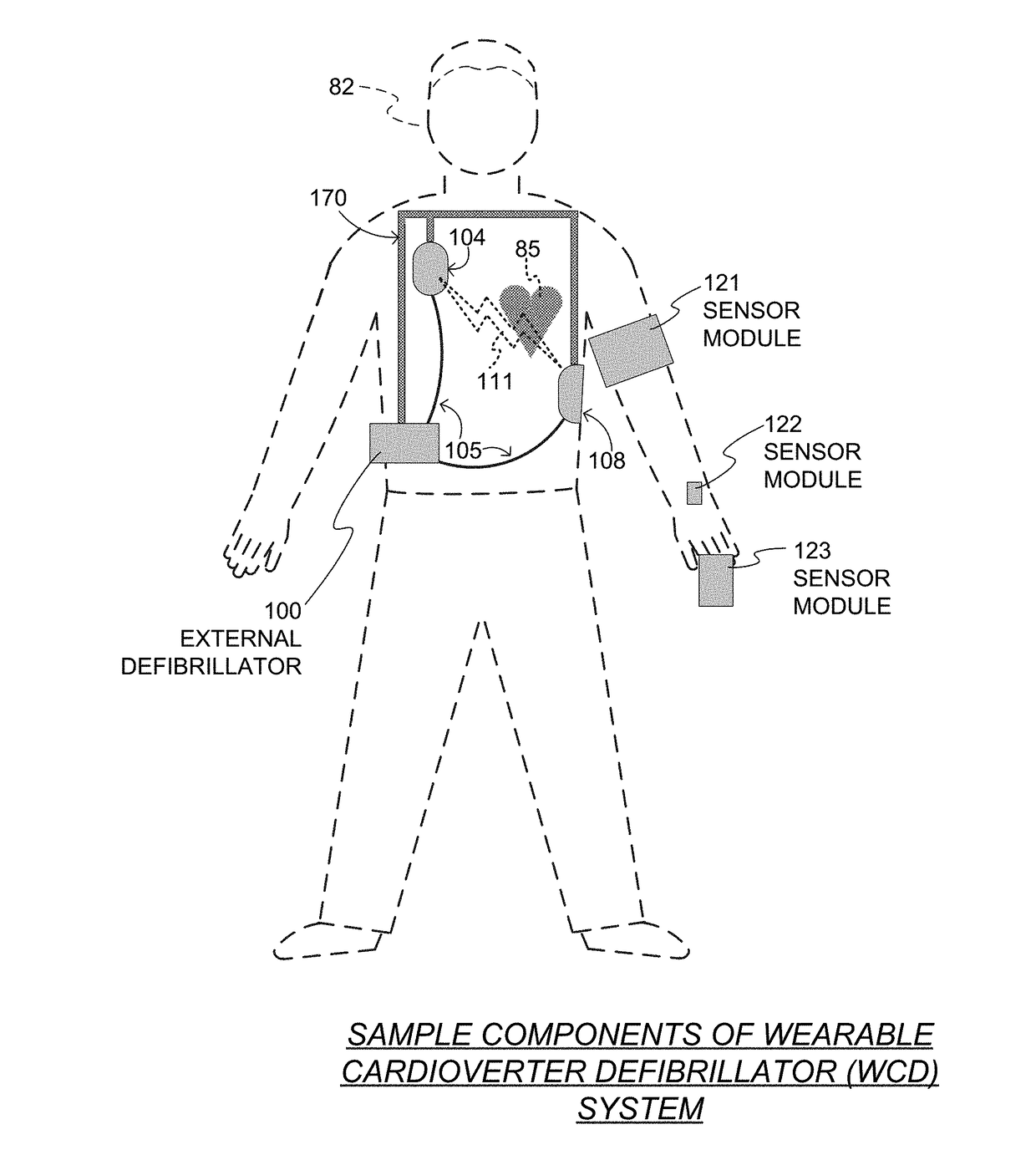 Wearable cardioverter defibrillator (WCD) system using sensor modules with reassurance code for confirmation before shock