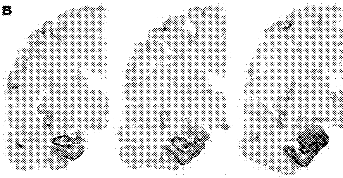 Method for preventing and/or treating chronic traumatic encephalopathy-iv