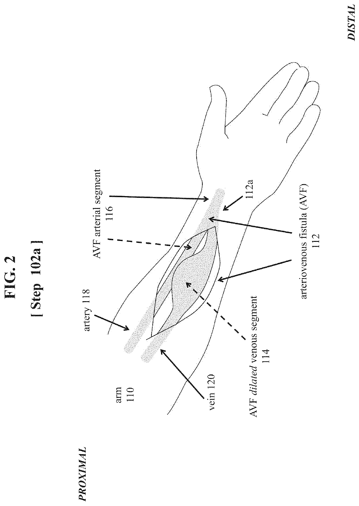 Method for treating an arteriovenous fistula (AVF) dilated venous segment in a hemodialysis patient whose arteriovenous fistula (AVF) exhibits abnormally high venous blood flow or/and pressure