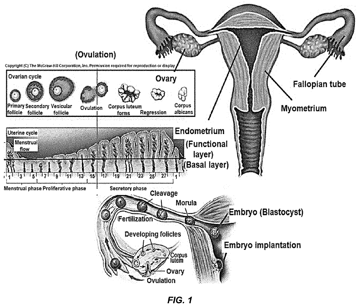 Diagnostic and treatment method for endometrial cavity distorting uterine leiomyoma using microrna