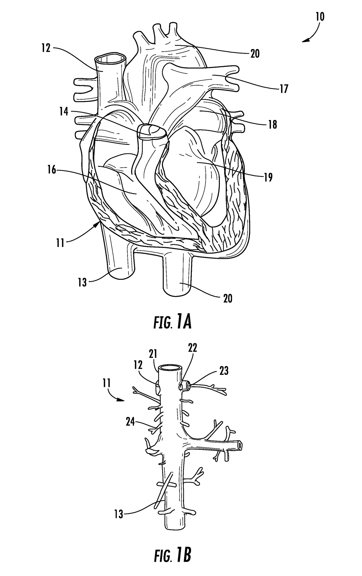System for treating acute and chronic heart failure