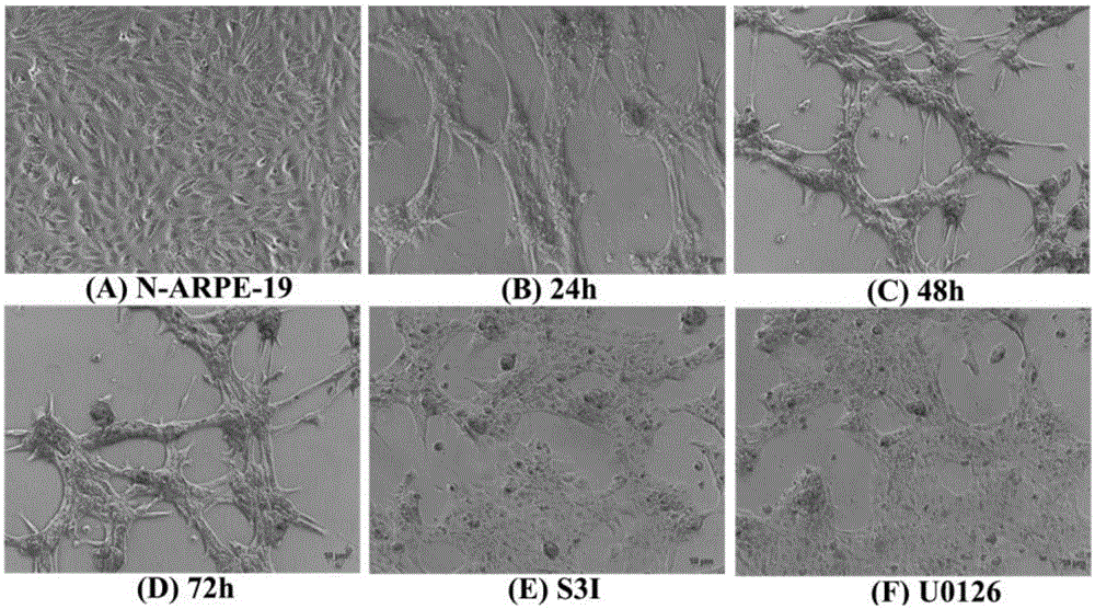 Retinal pigment epithelium epithelial-mesenchymal transition model and application thereof