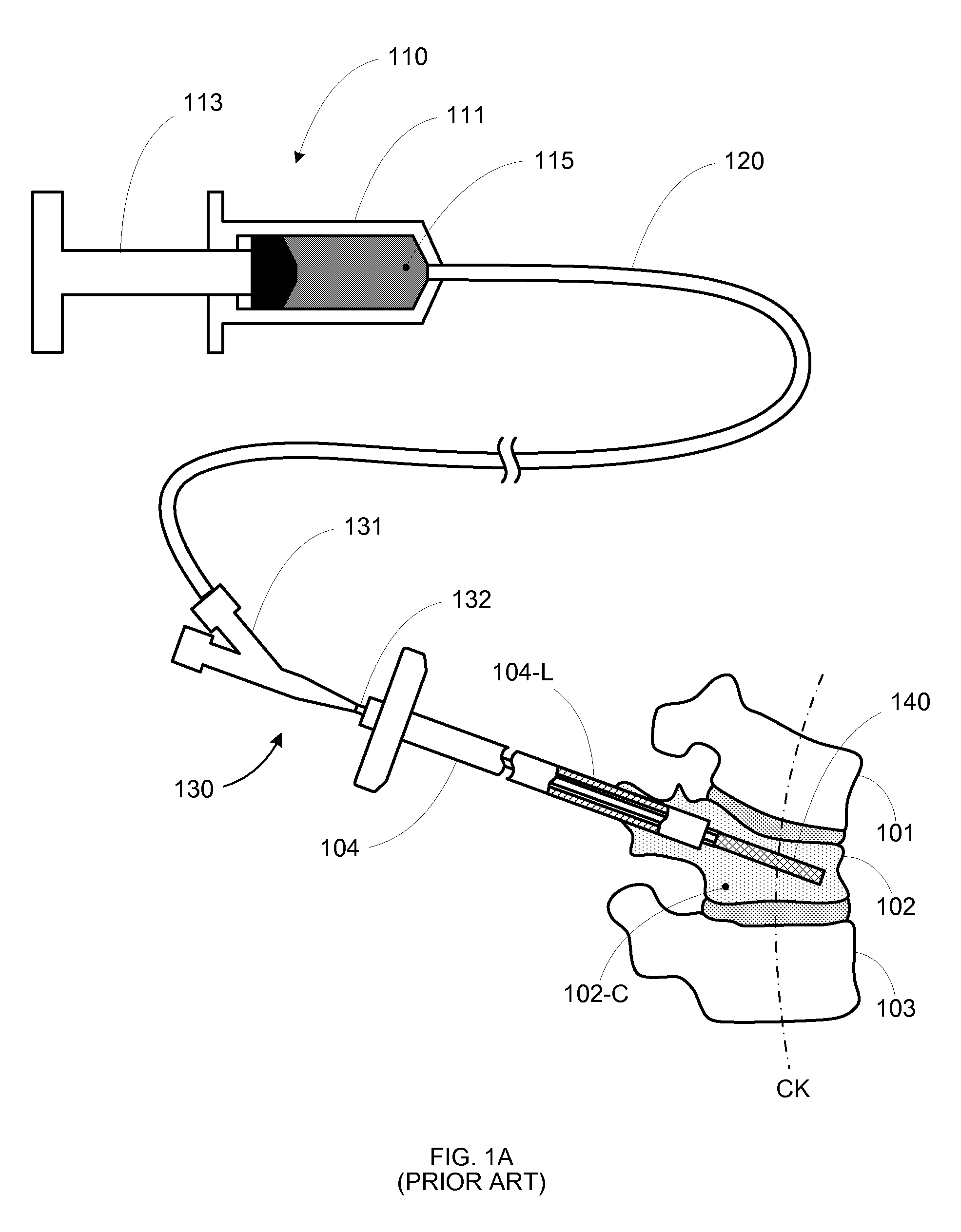 Anterior inflation balloon