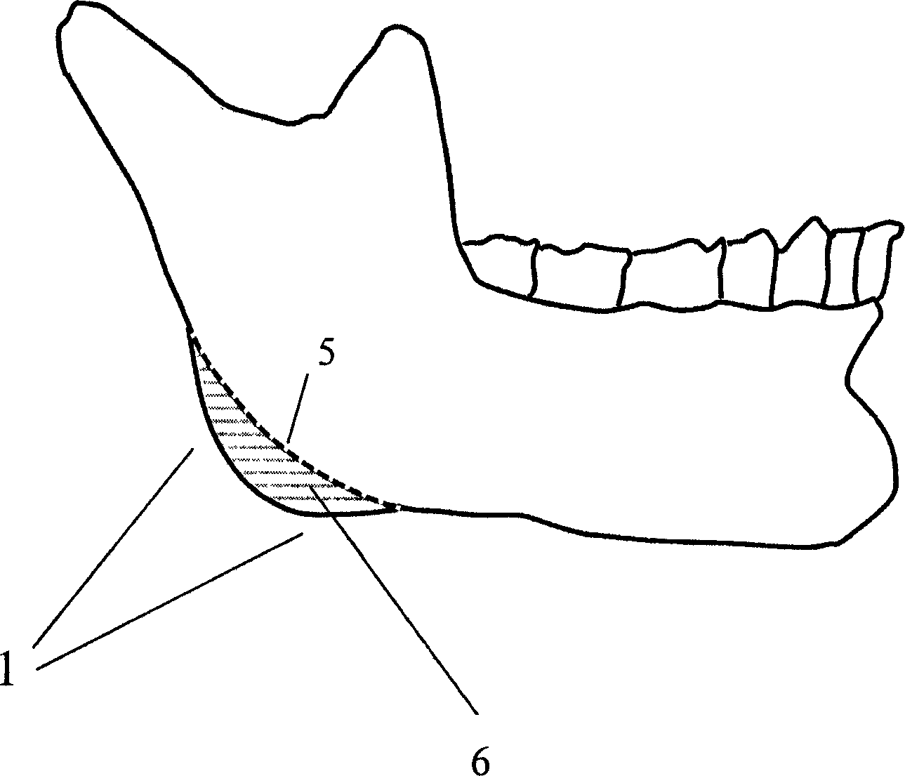 Shaping-area limiting device for angle of mandible and making method therefor