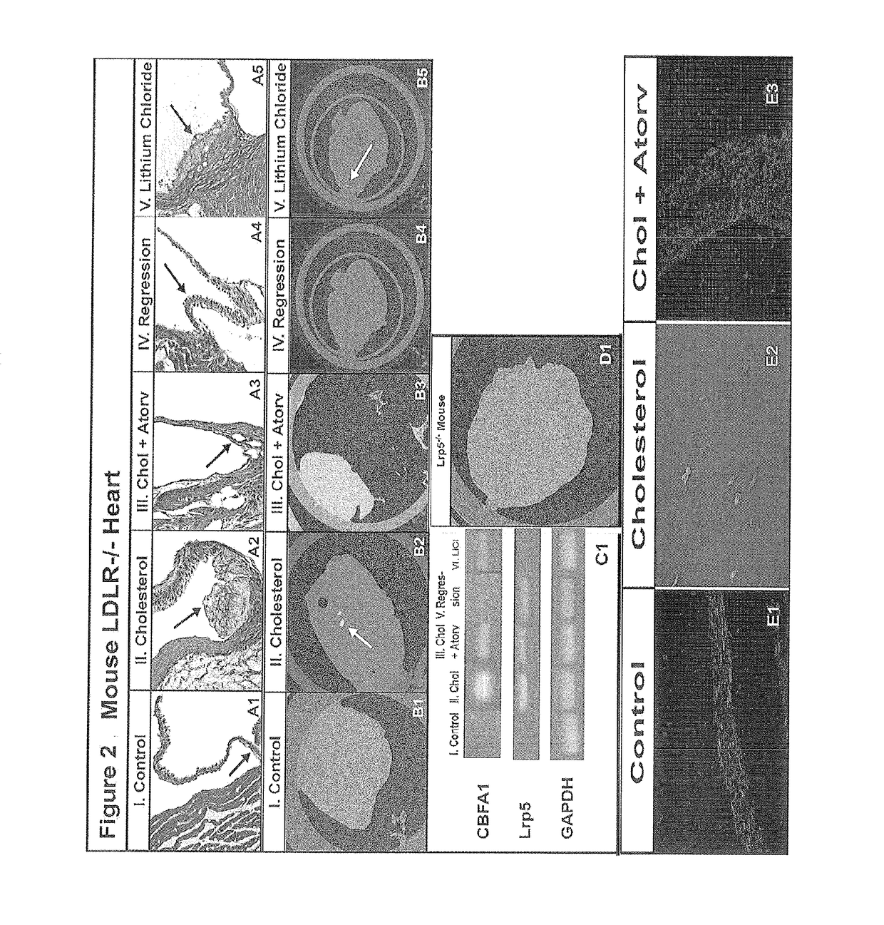 Devices and methods for inhibiting stenosis, obstruction, or calcification of a native heart valve, stented heart valve or bioprosthesis